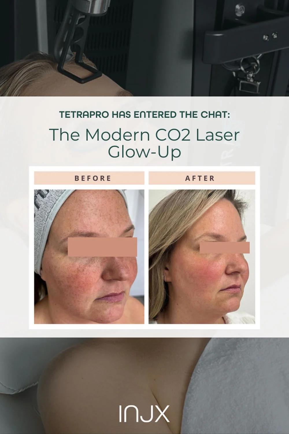 TetraPro CO2 laser treatment for skin rejuvenation in North Peoria.