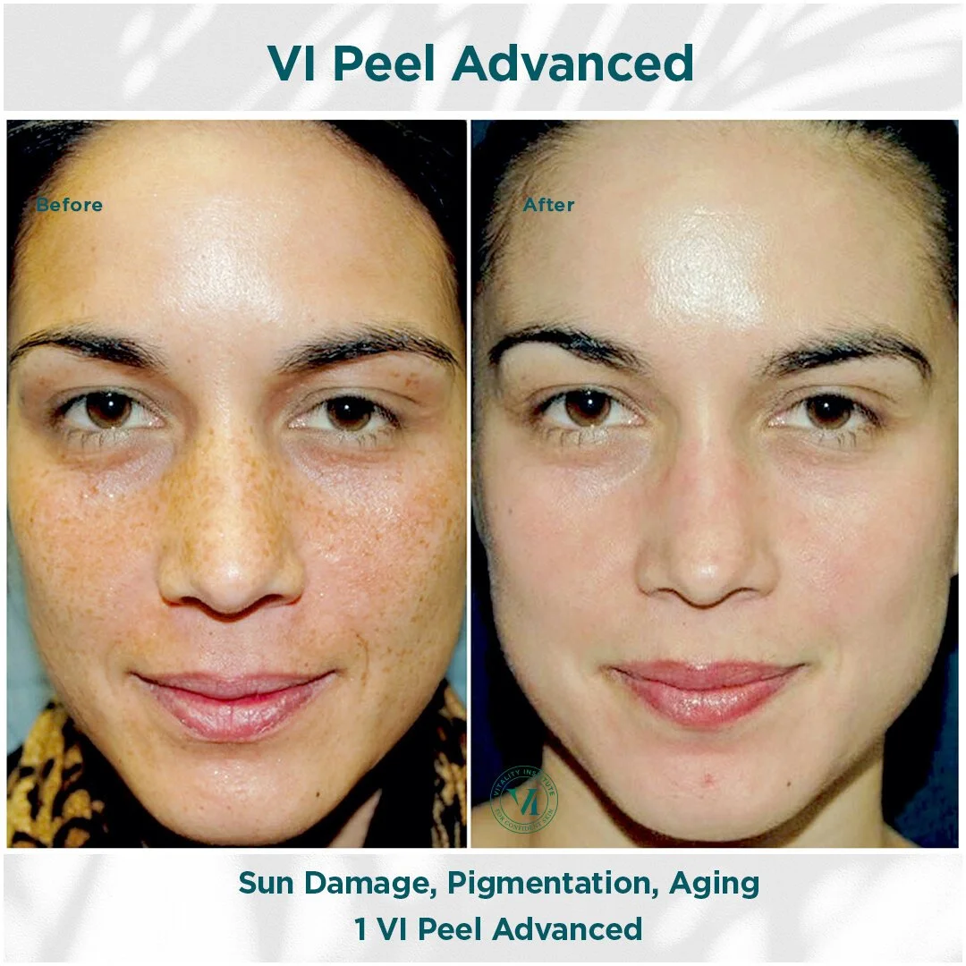  VI chemical Peel before and after 