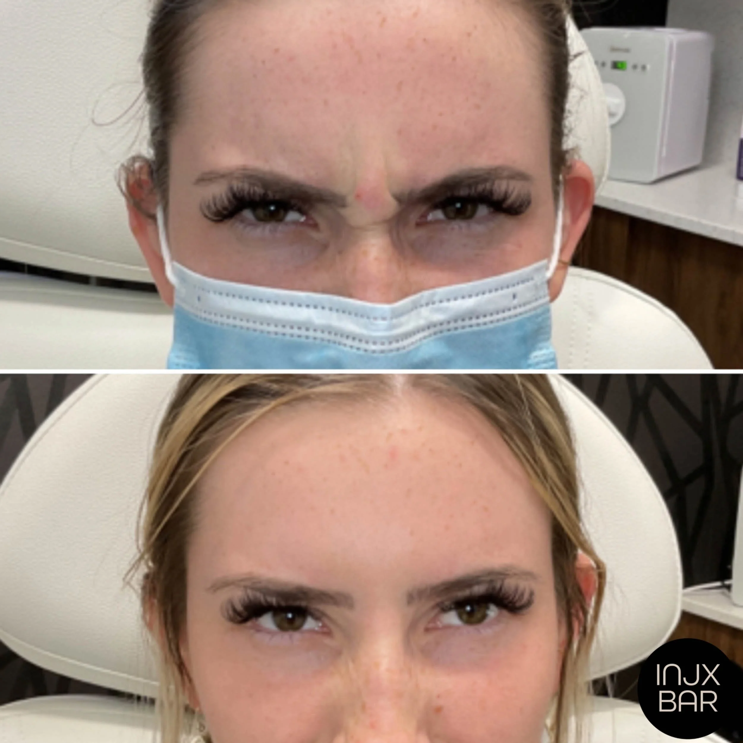 injx-bar-before-after-dysport-frown-lines.jpg