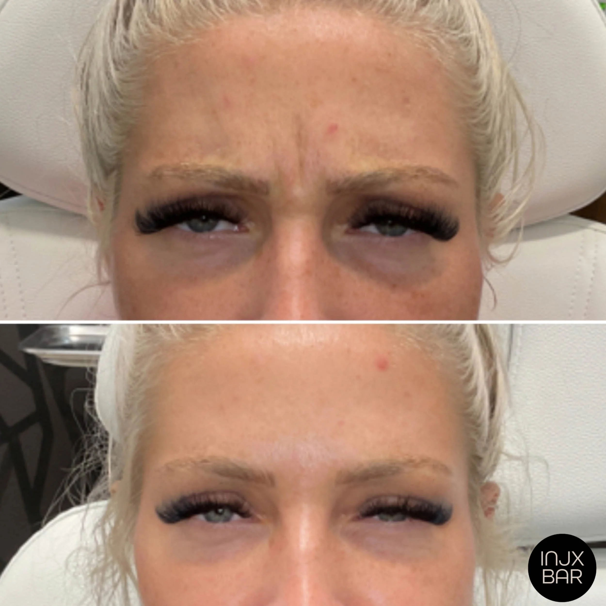 injx-bar-before-after-nueromodulator-frown-lines.jpg