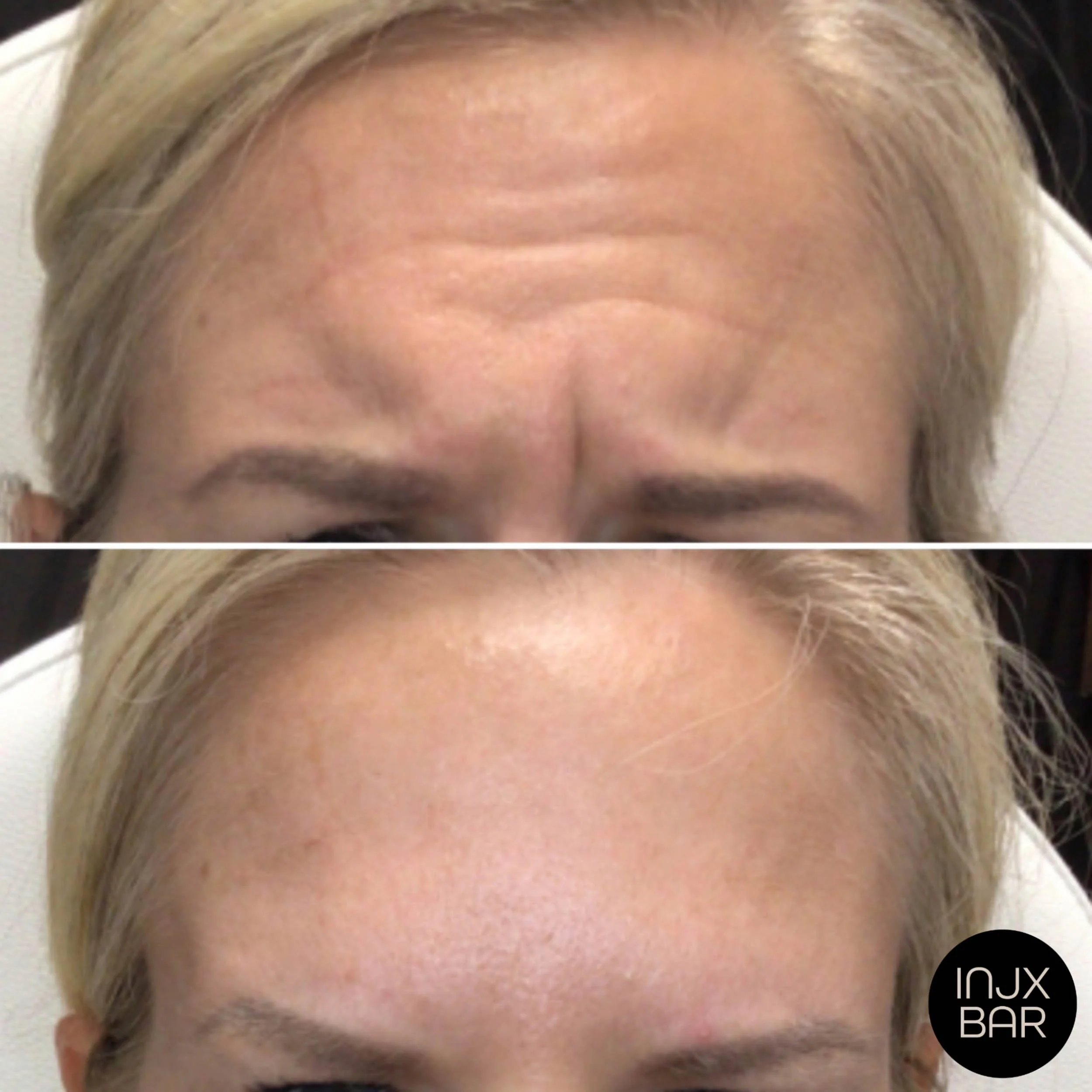  Before and 2 weeks after Xeomin treatment  for frown lines. 