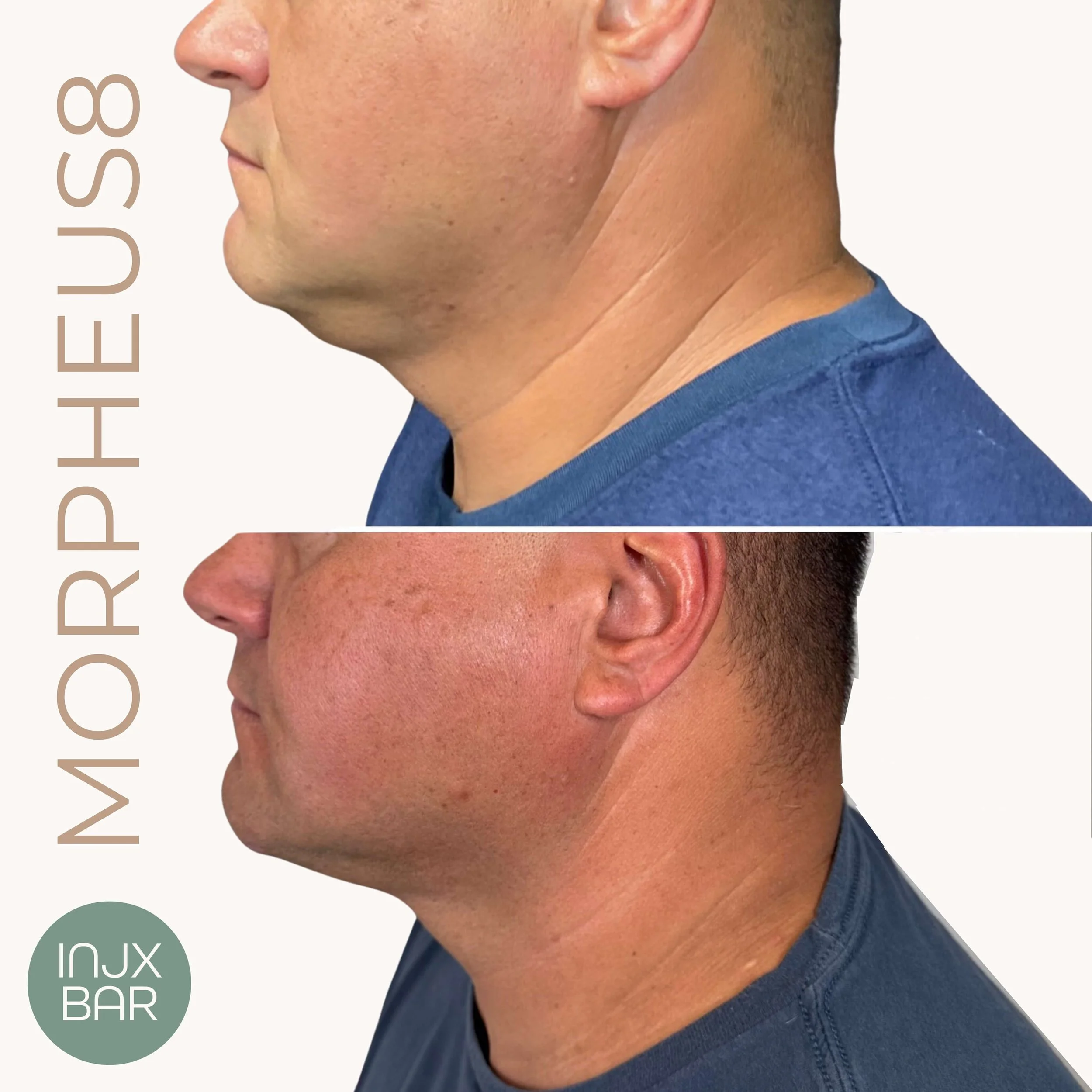  Morpheus8 to minimize submental fat or a “double chin” and to define the jawline 
