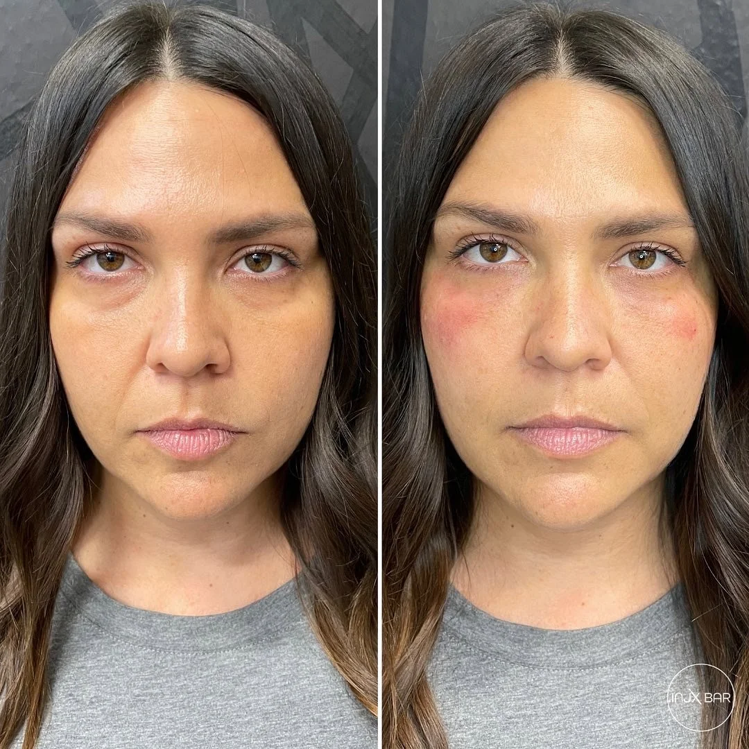  Before and After Under Eye Filler 