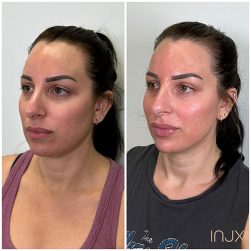  Facial balancing with dermal filler- chin filler, cheek filler, and lip filler    