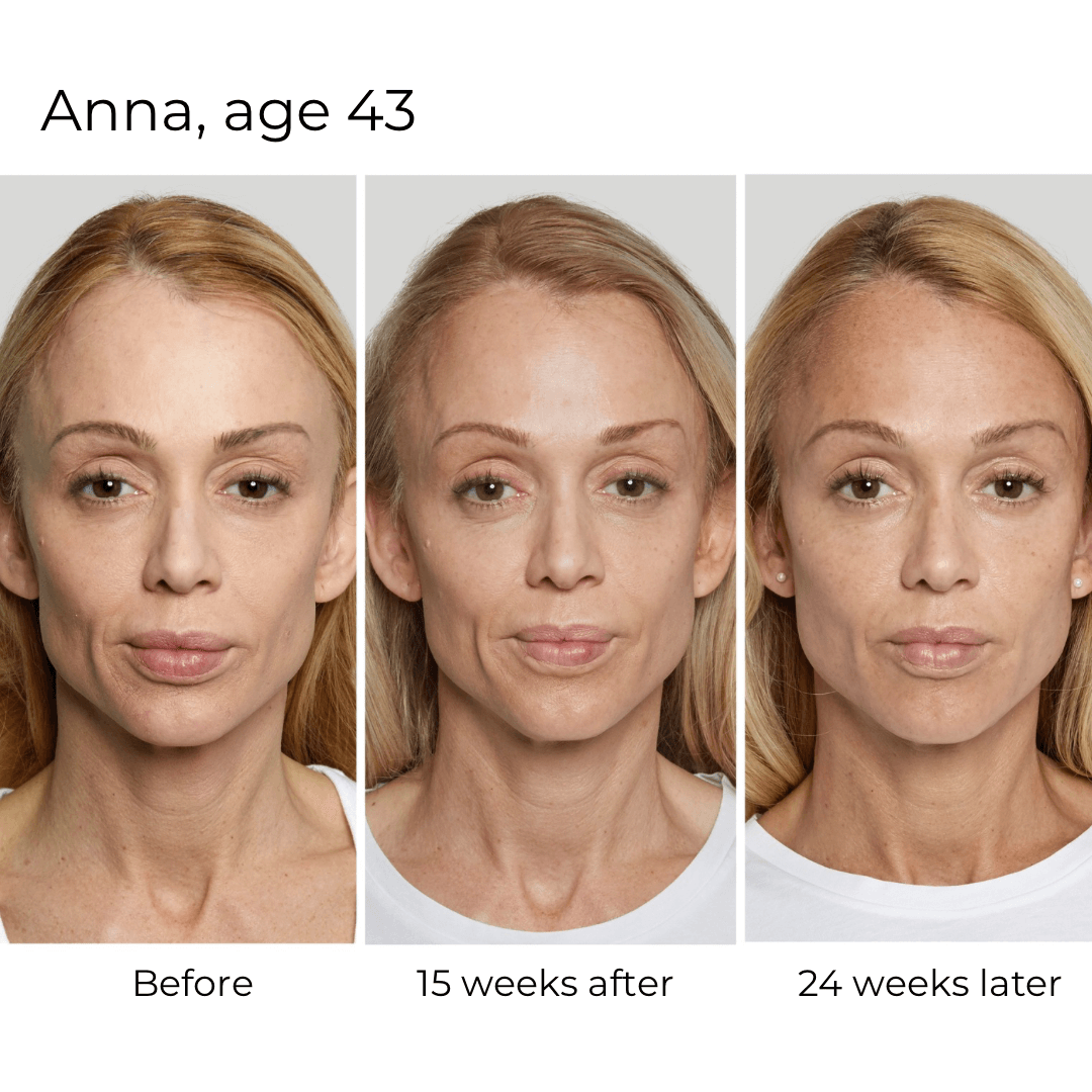 sculptra-injections-before-and-after.png