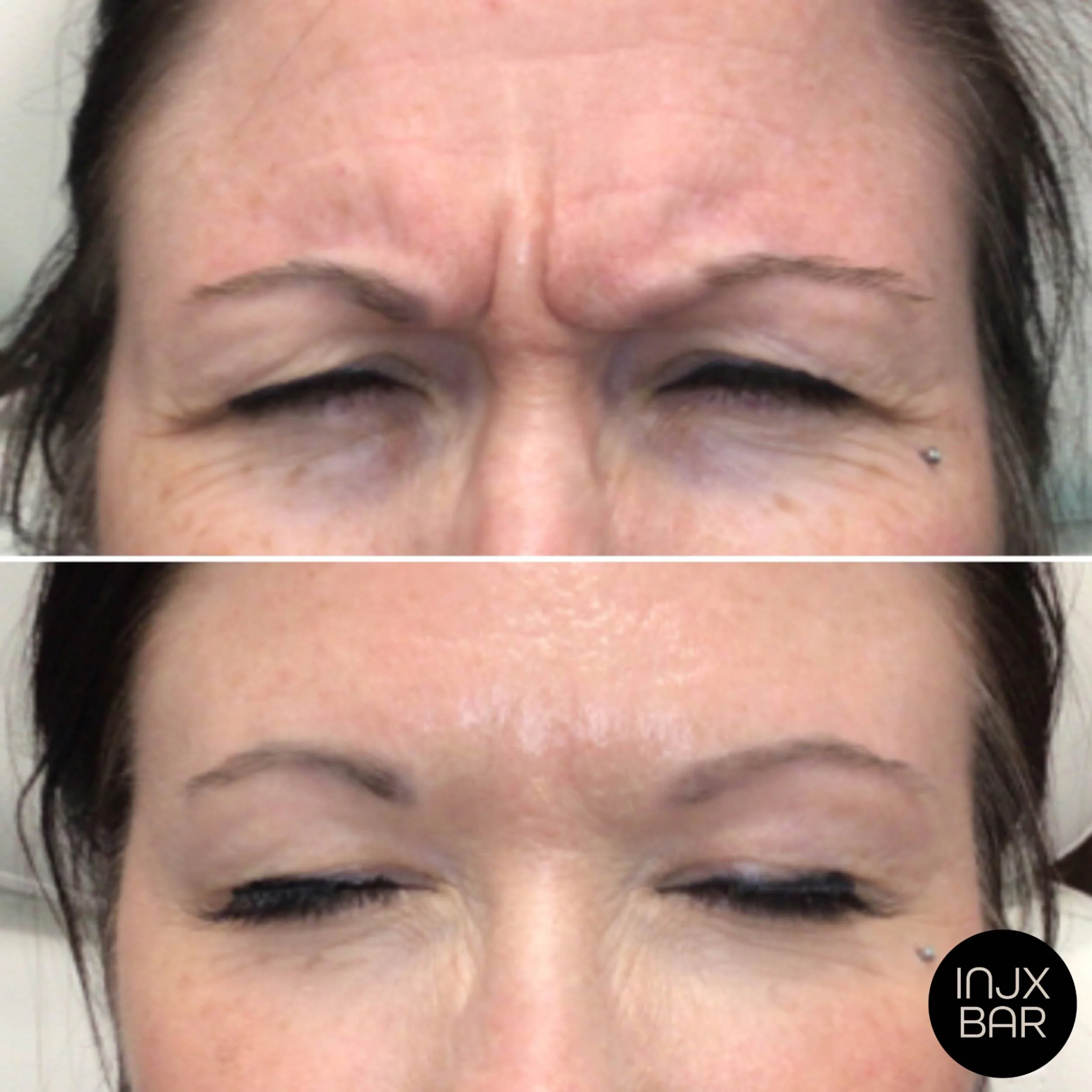 injx-bar-before-after-botox-treatment-frown-lines.jpg