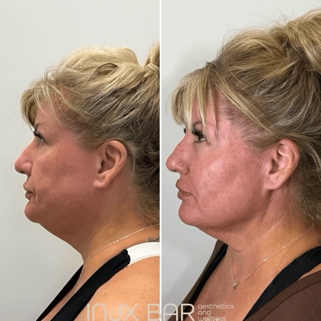  Face and neck Morpheus8 for skin tightening and facial sculpting. Areas of focus: neck and jawline 