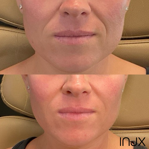  Before and After Juvederm for Smile Lines    