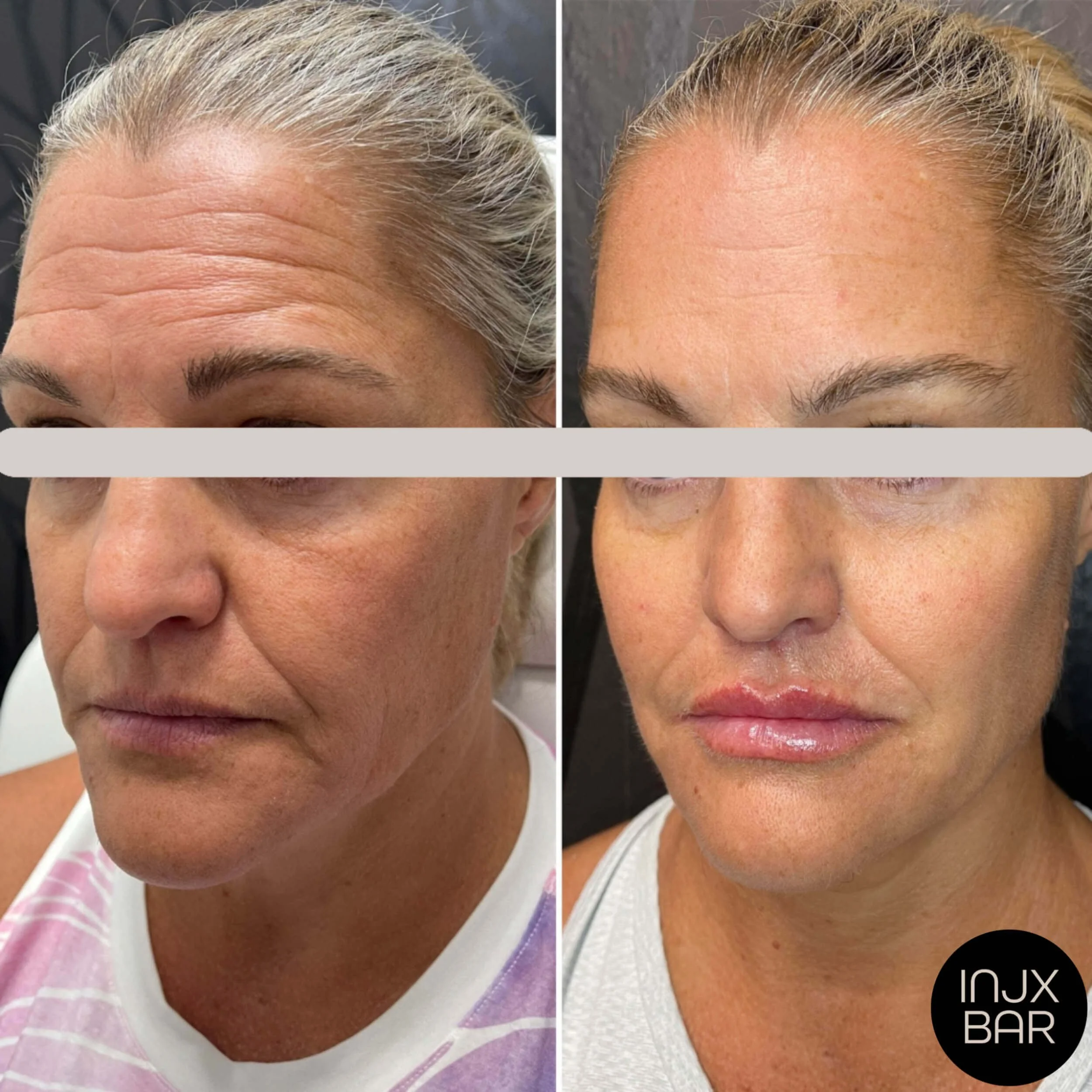 injx-bar-before-after-botox-facial-balancing.jpg