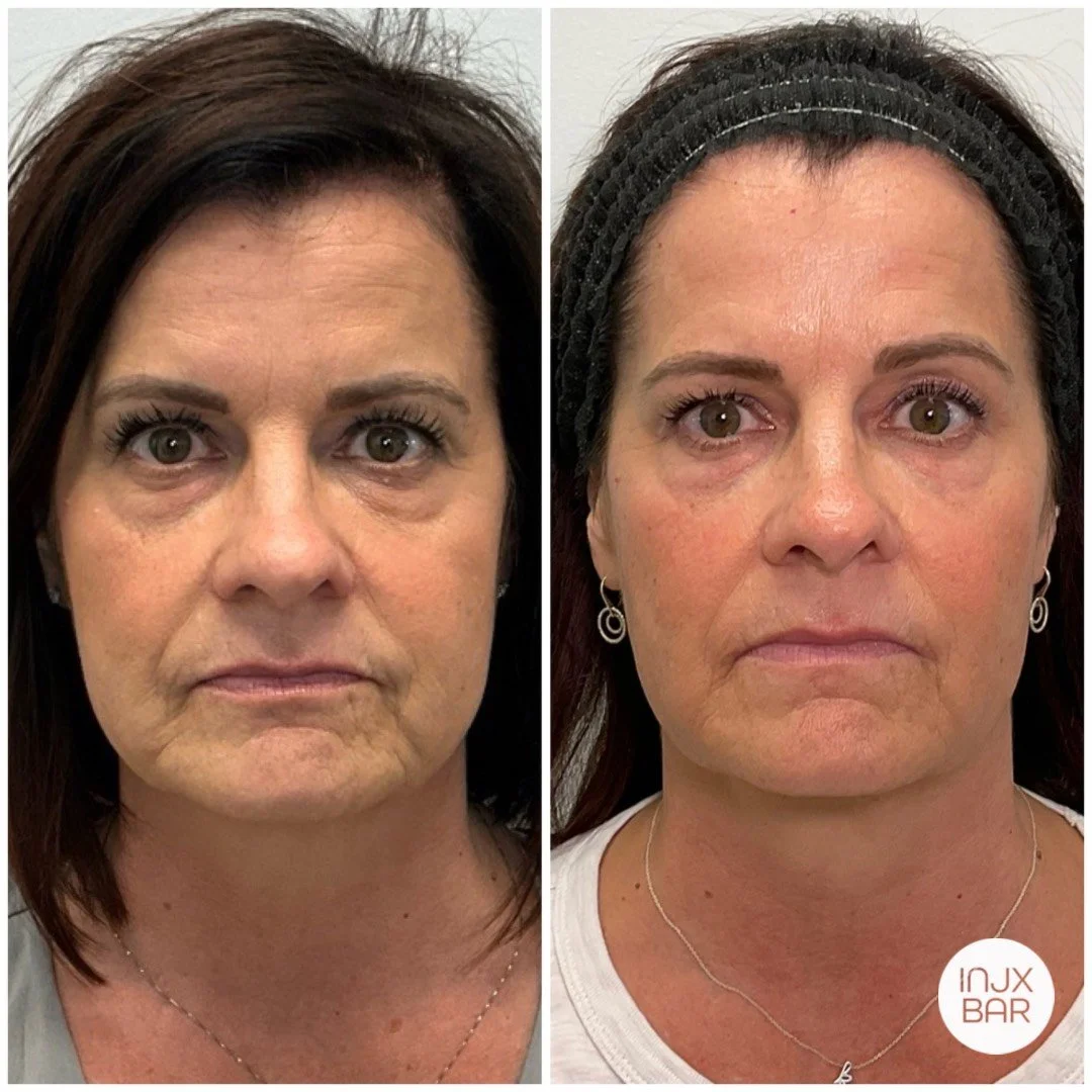 before-after-sculptra-treatment-near-me.jpg