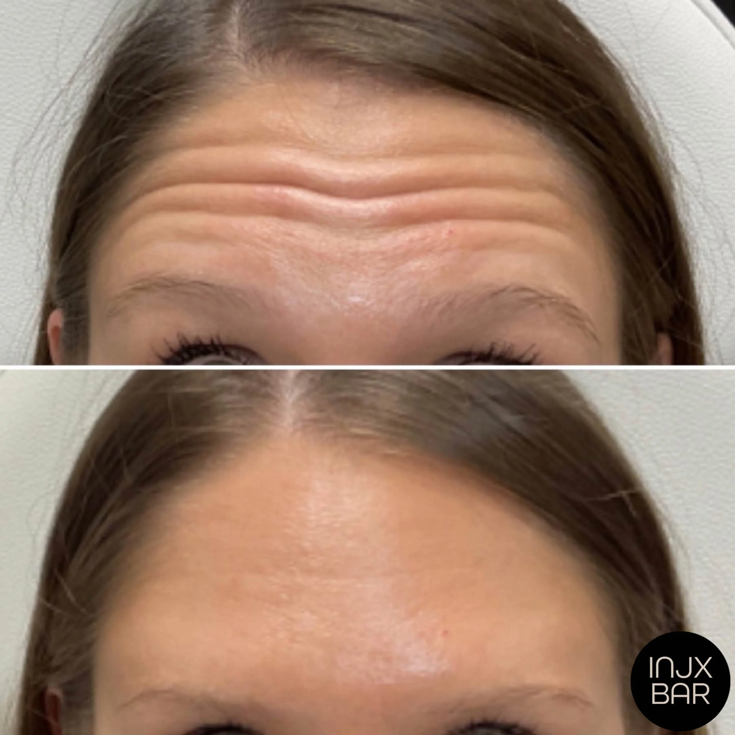  Before and 2 weeks after Xeomin treatment  for forehead lines. 