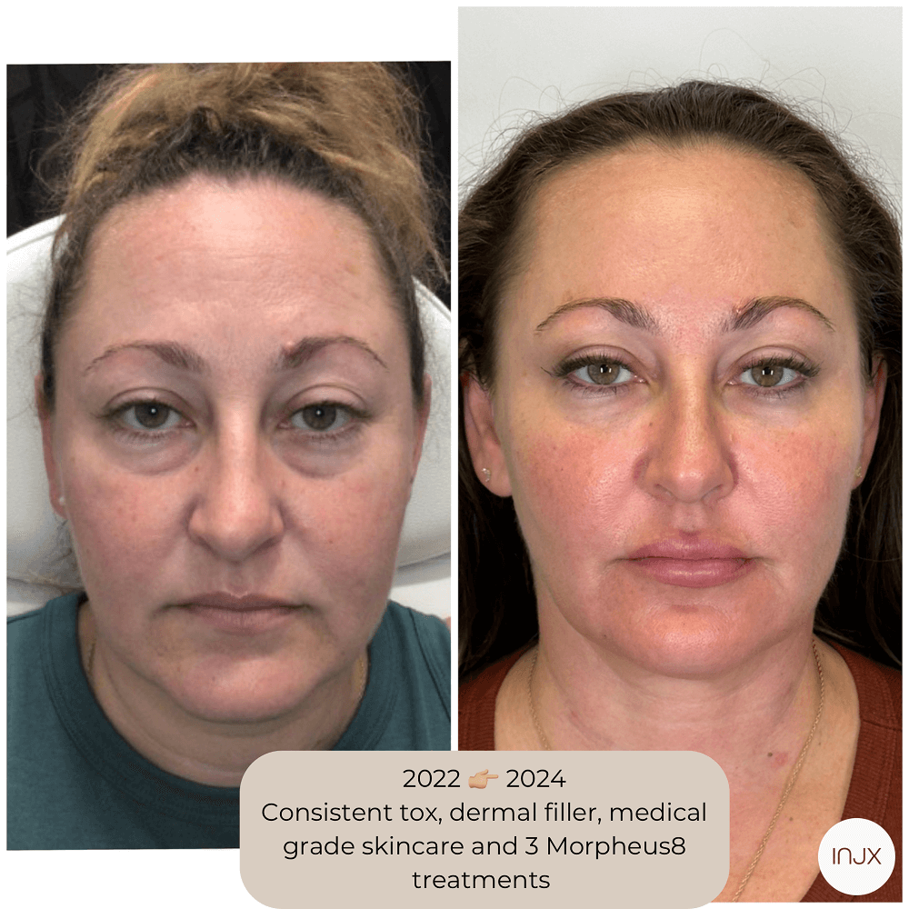  Series of 3 Morpheus8 treatments plus facial balancing with dermal filler and Botox 