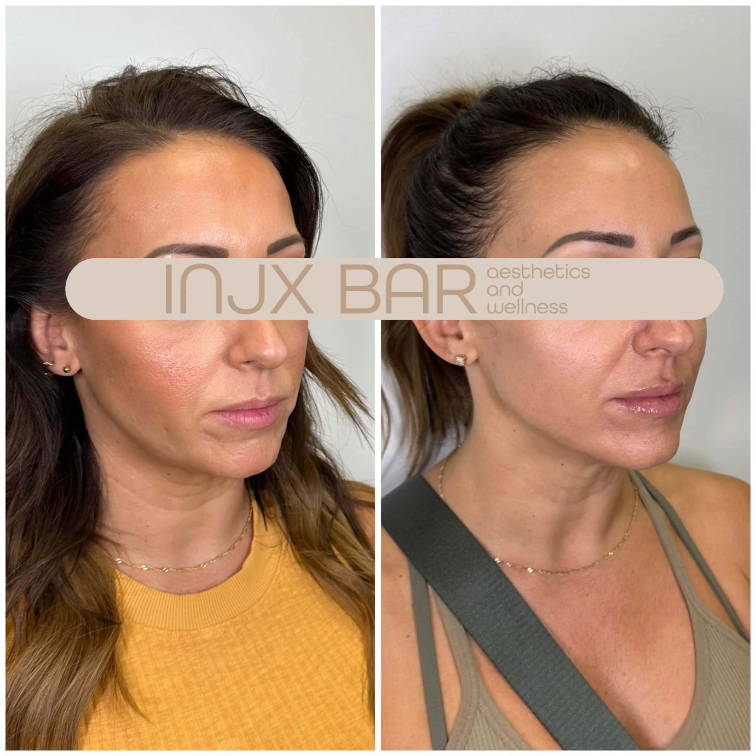 injx-bar-before-after-facial-balancing.jpg