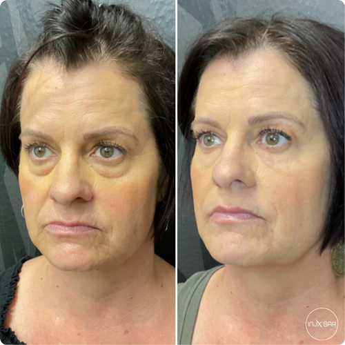  Before and After Under Eye Filler 