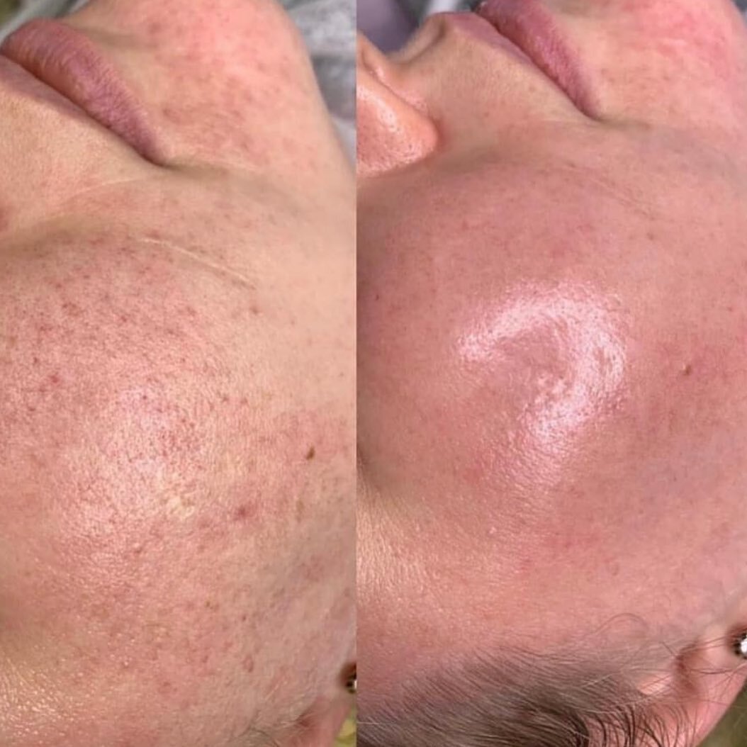 Before and after 6 Unicorn Facial treatments 1 week apart. 
✨ Addresses scarring, pigmentation, fine lines and wrinkles. 
Series come with an at-home car kit. 
👉 Link in bio for more info and to book.
#millvalley #prxt33marin #nextdoorfave #antiagin