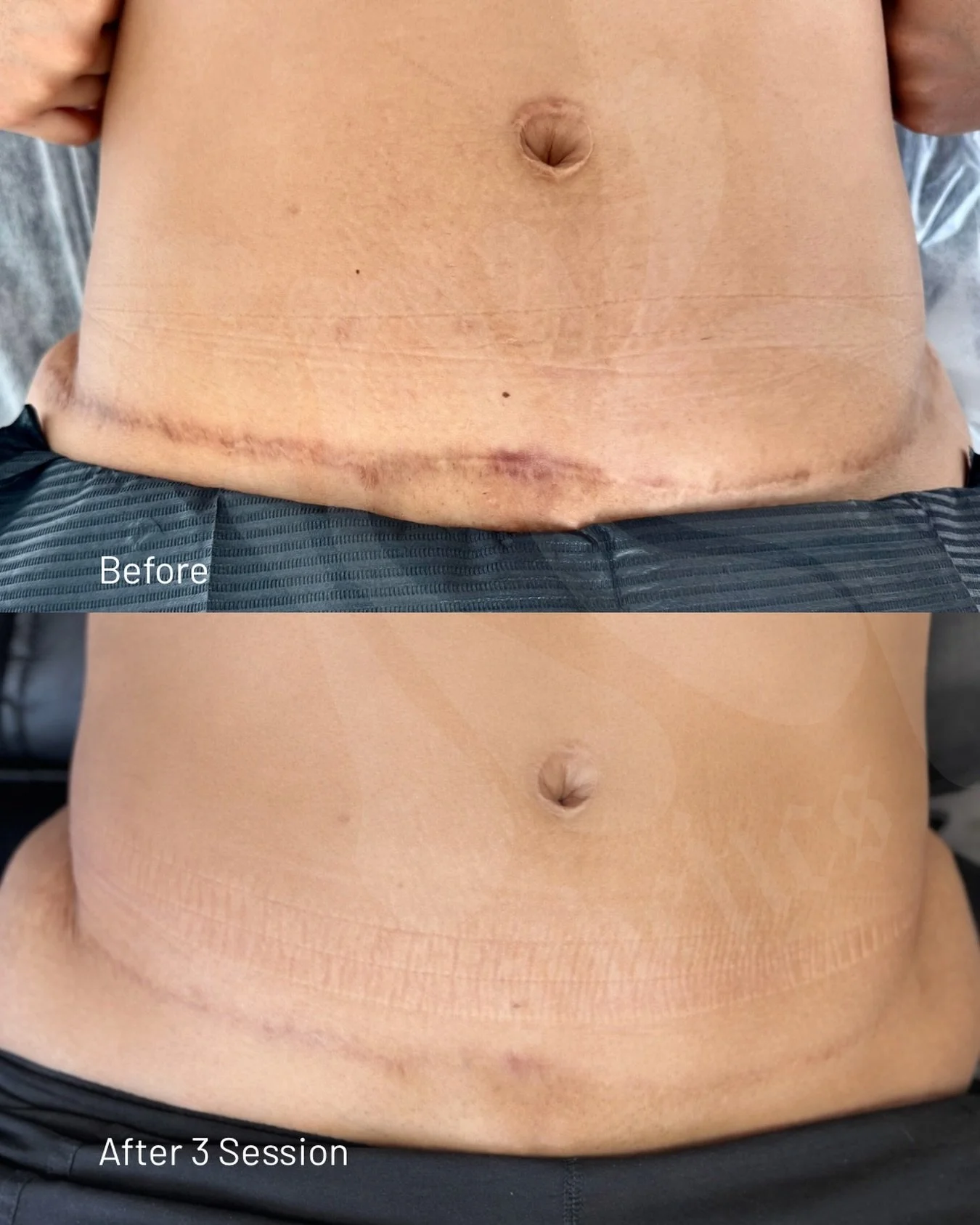 Patience, patience &amp; more patience!

My client had one request to minimize her scar &amp; I think we achieved that really well. 

She knew she's had the tummy tuck scar for a while and it won't just go away overnight. But she was the ultimate exa