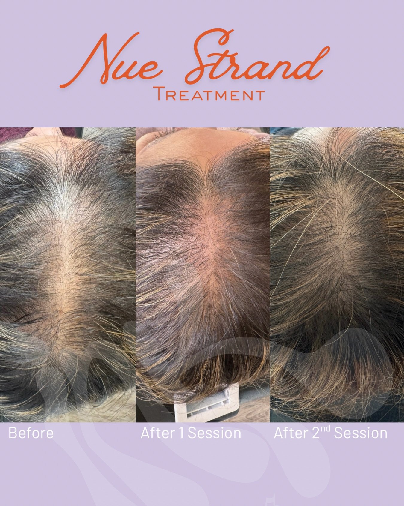 LOOK AT THE DIFFERENCE IN JUST FEW WEEKS!!!!!

This medical-grade serum stimulates natural hair growth, strengthens existing strands, and restores scalp health from within.

If you&rsquo;ve noticed thinning or shedding, this treatment might be your s
