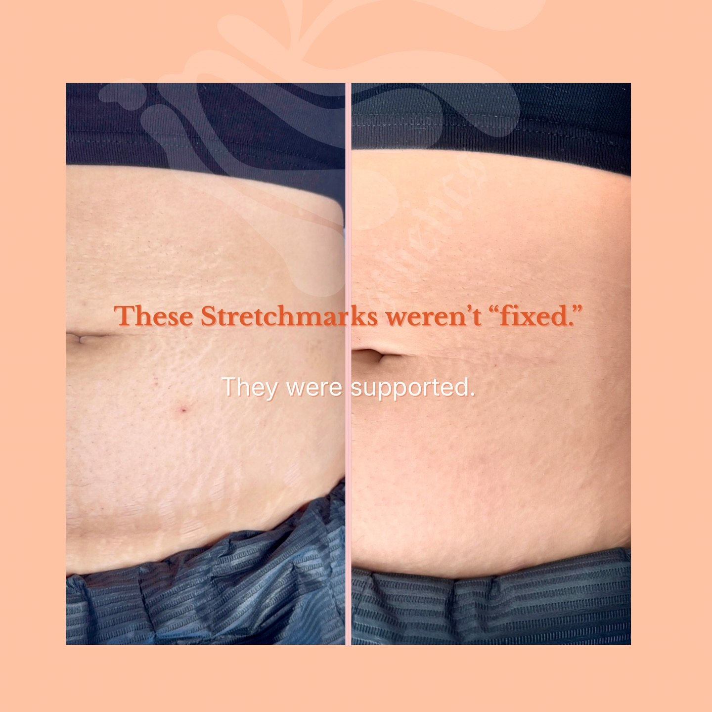 Healing takes time.. 

Something that has been part of your body for many years is not going to disappear in 1 night.

You must give your body the right nutrients to hear these stretchmarks. 

This is 1/3 session. And just in one round we see a great