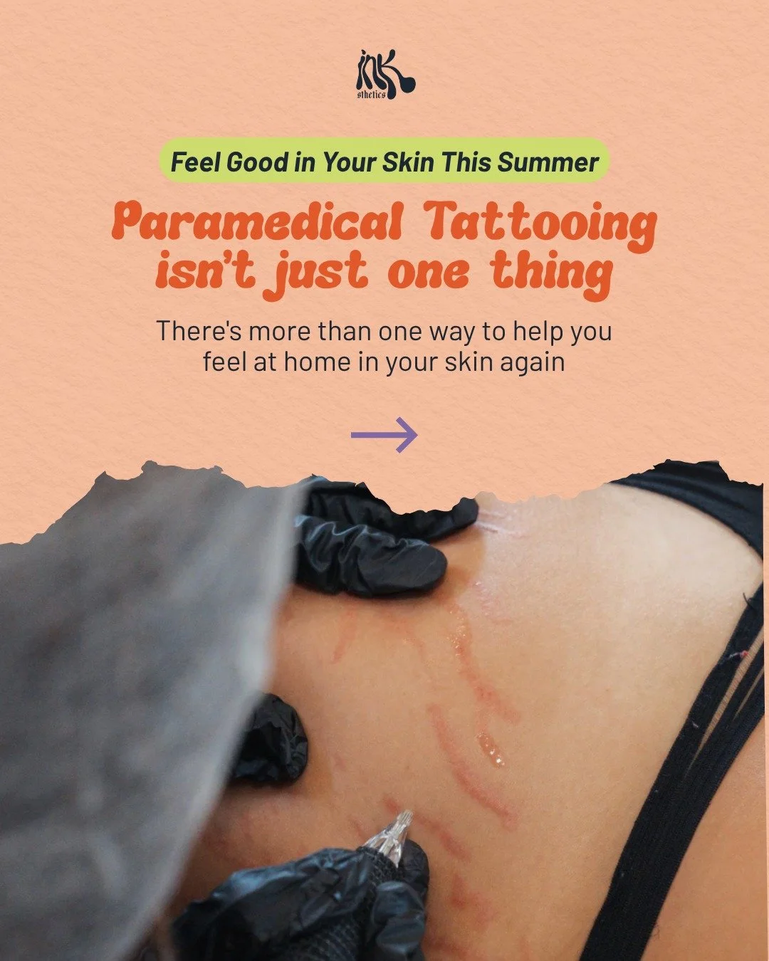 Paramedical tattooing doesn't just encompass scars and stretch marks, it's so much more than that.

It's about covering up history you'd like to leave behind. Maybe it's a scar that always catches your eye no matter how hard you try to ignore it. Or 
