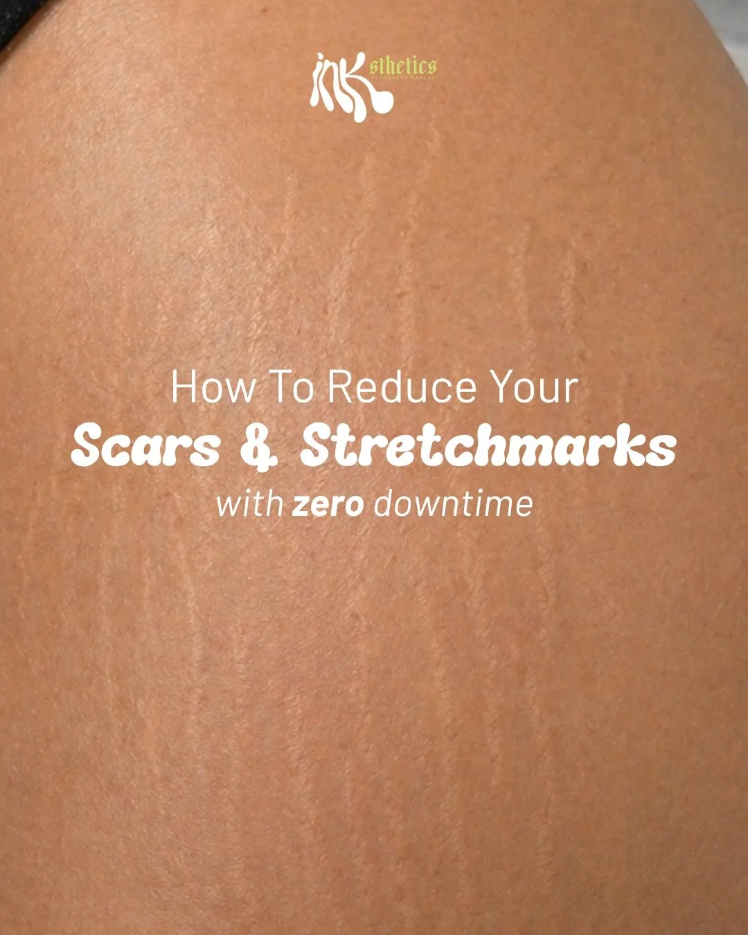 What surprises our clients the most? There&rsquo;s ZERO downtime when camouflaging scars and stretch marks.

(And no, we&rsquo;re not exaggerating when we say zero. 🤍)

Right after your appointment, you&rsquo;re free to stand up, walk around, move y