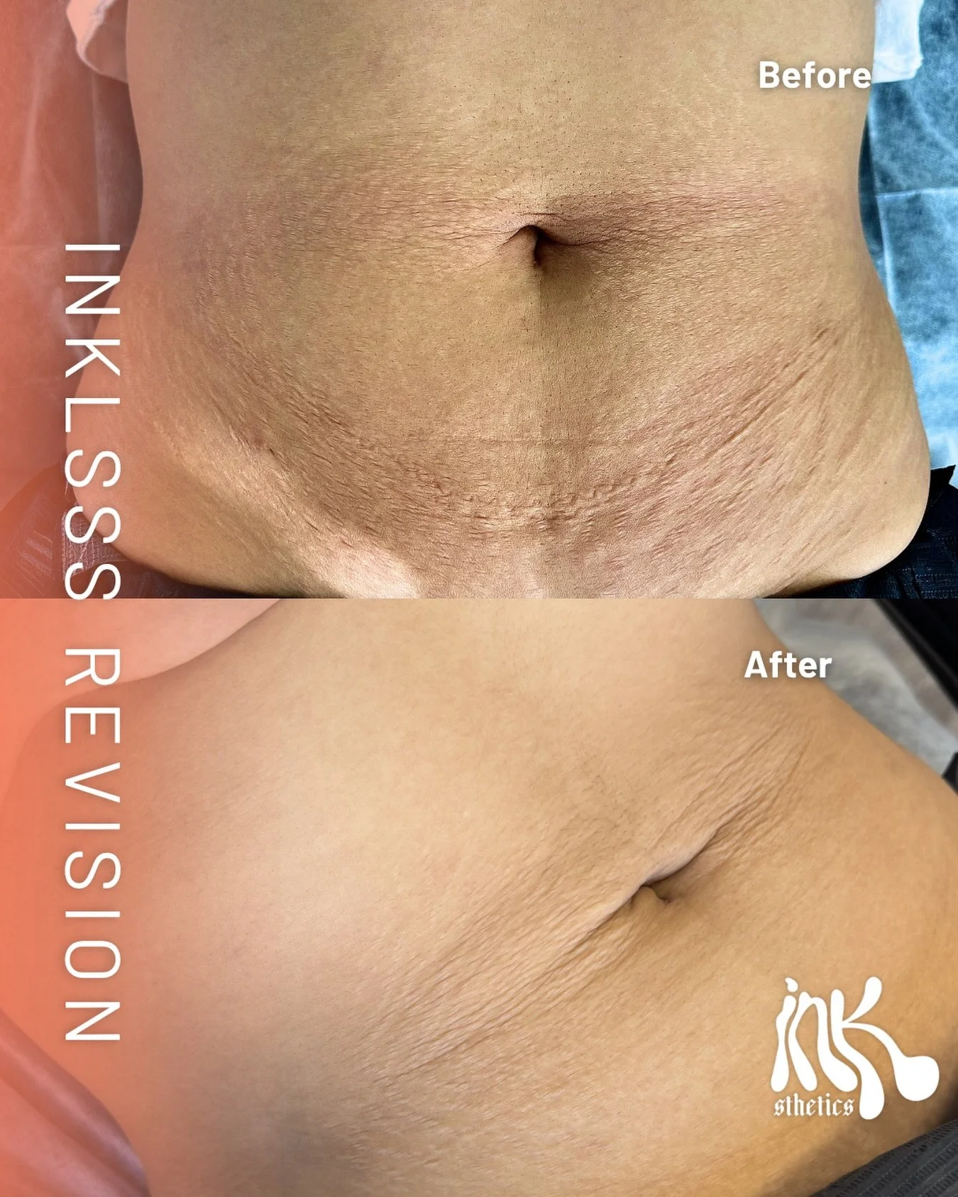 The kind of results you see with our Inkless Stretch Mark Revision ...and this is just after the first session.

With Inkless Stretch Mark Revision, you&rsquo;ll start seeing immediate results around 48 hours after your first appointment. But we alwa