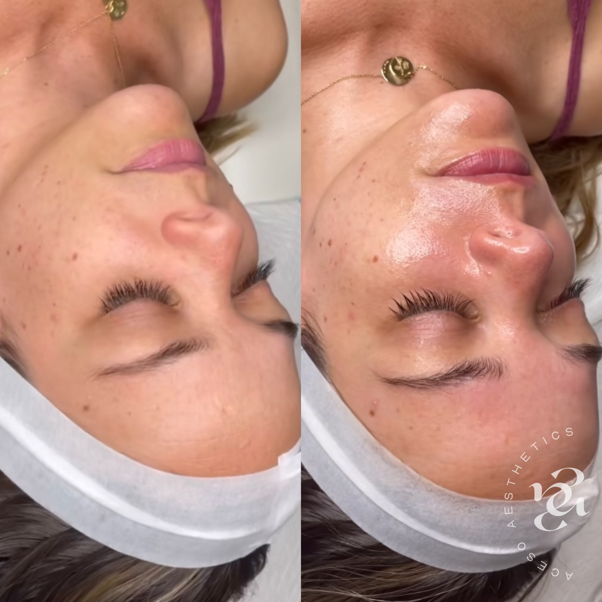 Facials Square post - with Aceso Logo 2.PNG