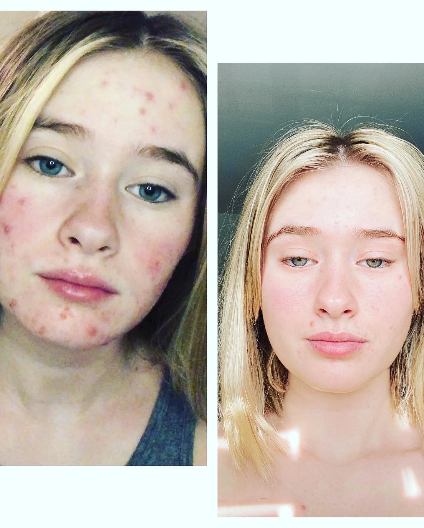 Best organic vegan skincare for aging, acne-prone, and sensitive skin—reduces wrinkles, fades sun spots, clears breakouts, and heals skin sensitive calms cystic acne wrinkles face lift removes eye wrinkles and crows feet sun damage hyperpigmentation