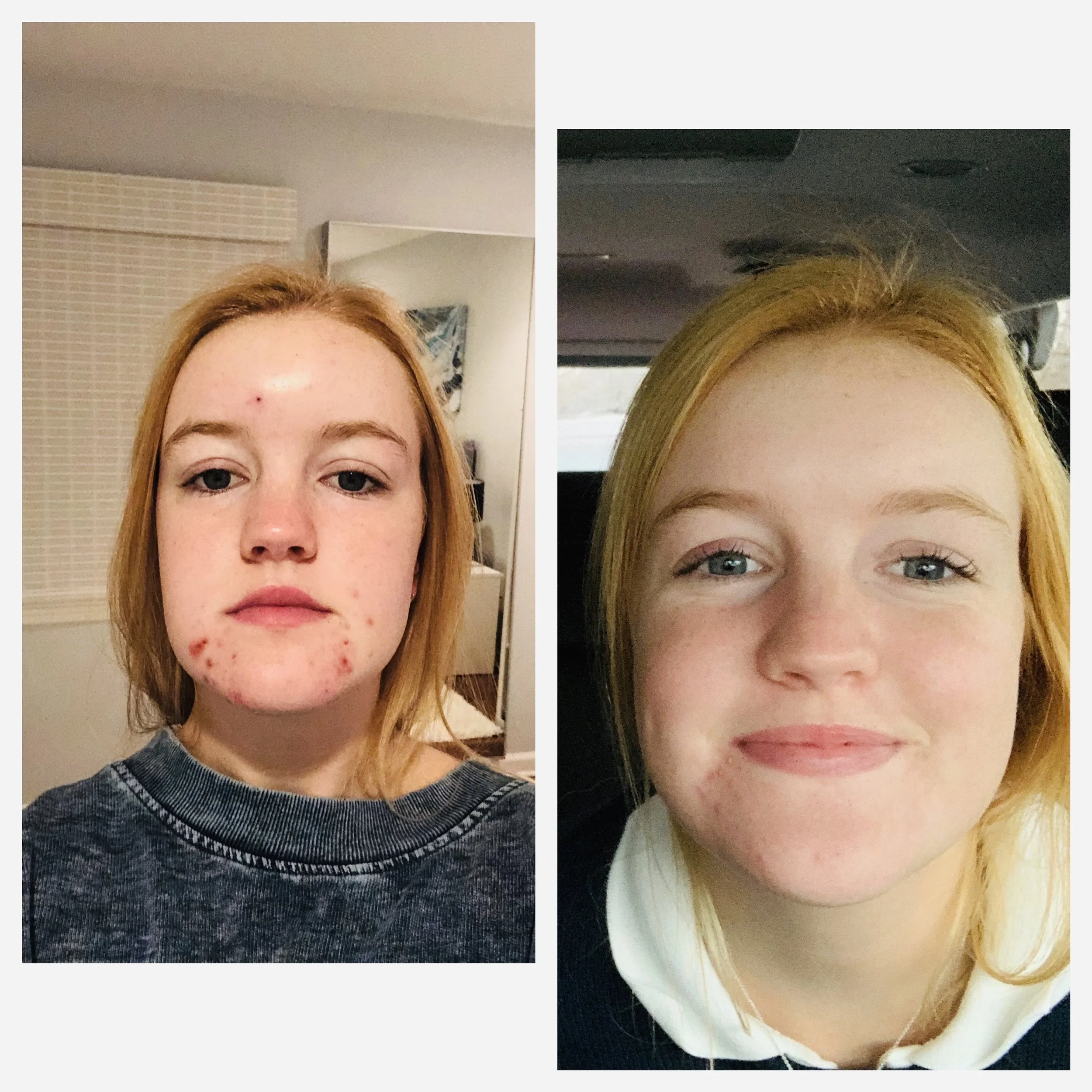 Side-by-side comparison of a young woman with red hair, showing her face with acne on the left and clear skin on the right.