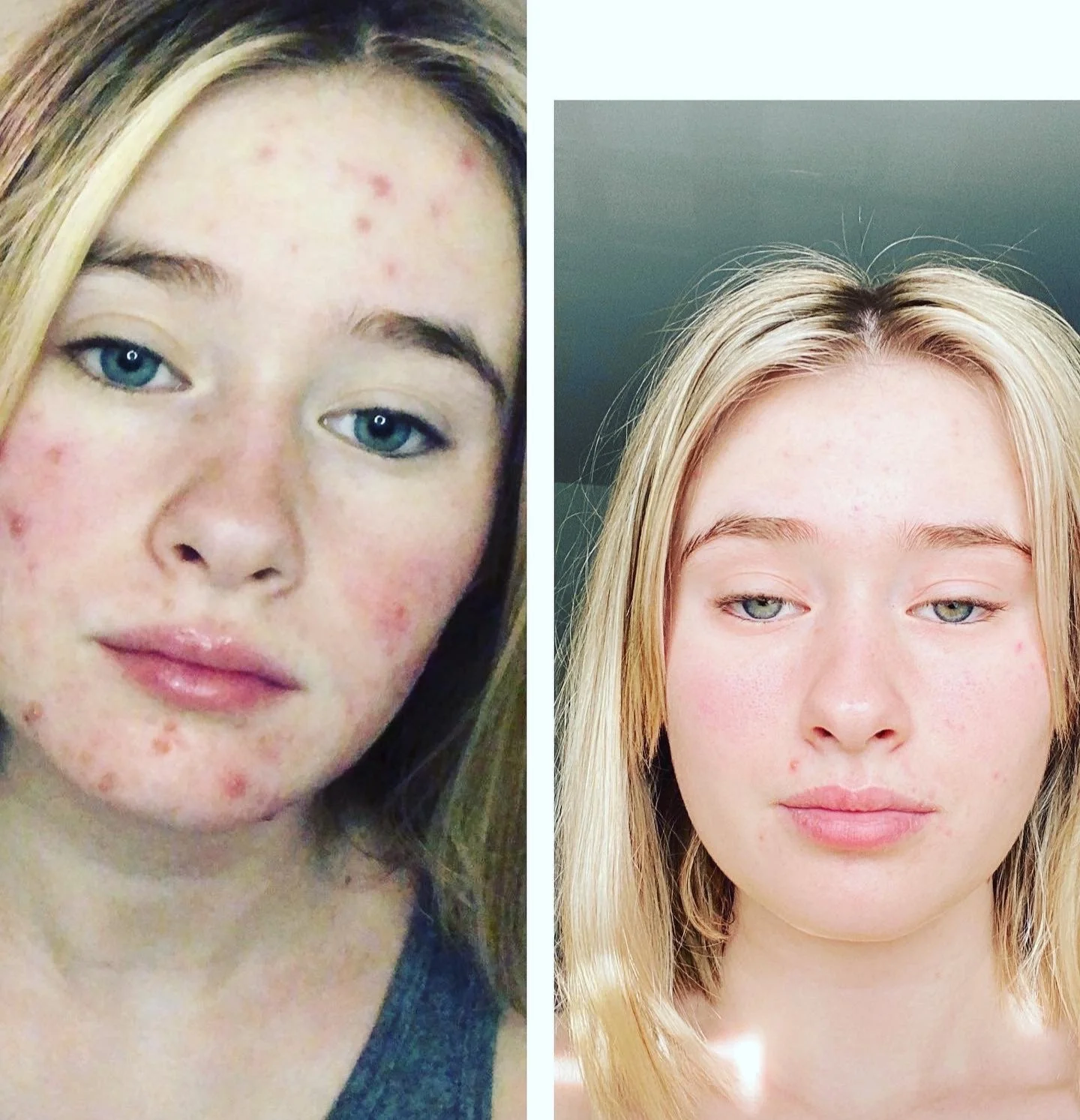 Side-by-side comparison of a woman's face before and after skincare, with visible improvements in skin clarity and texture.