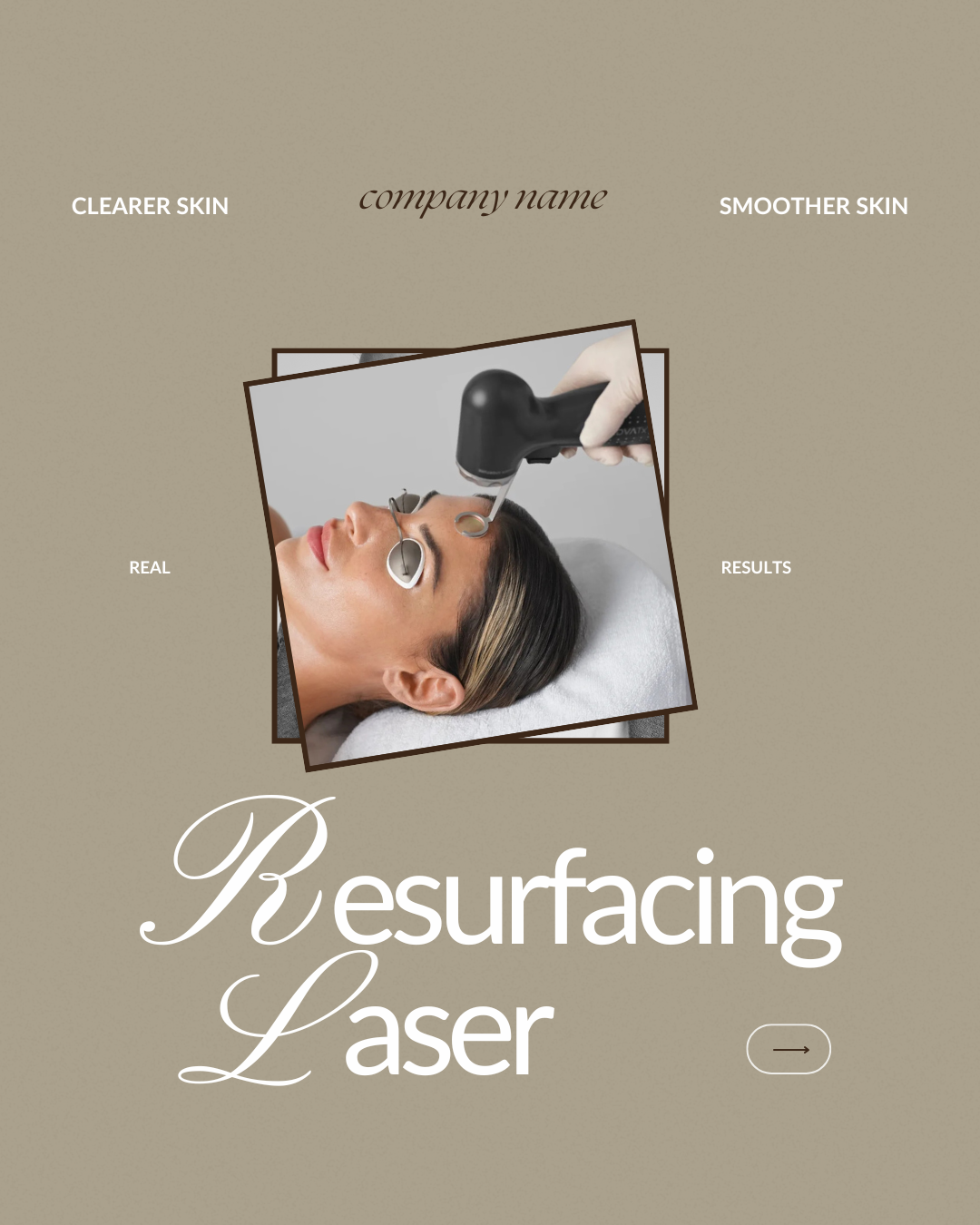 Resurfacing Laser - CAROUSEL.png