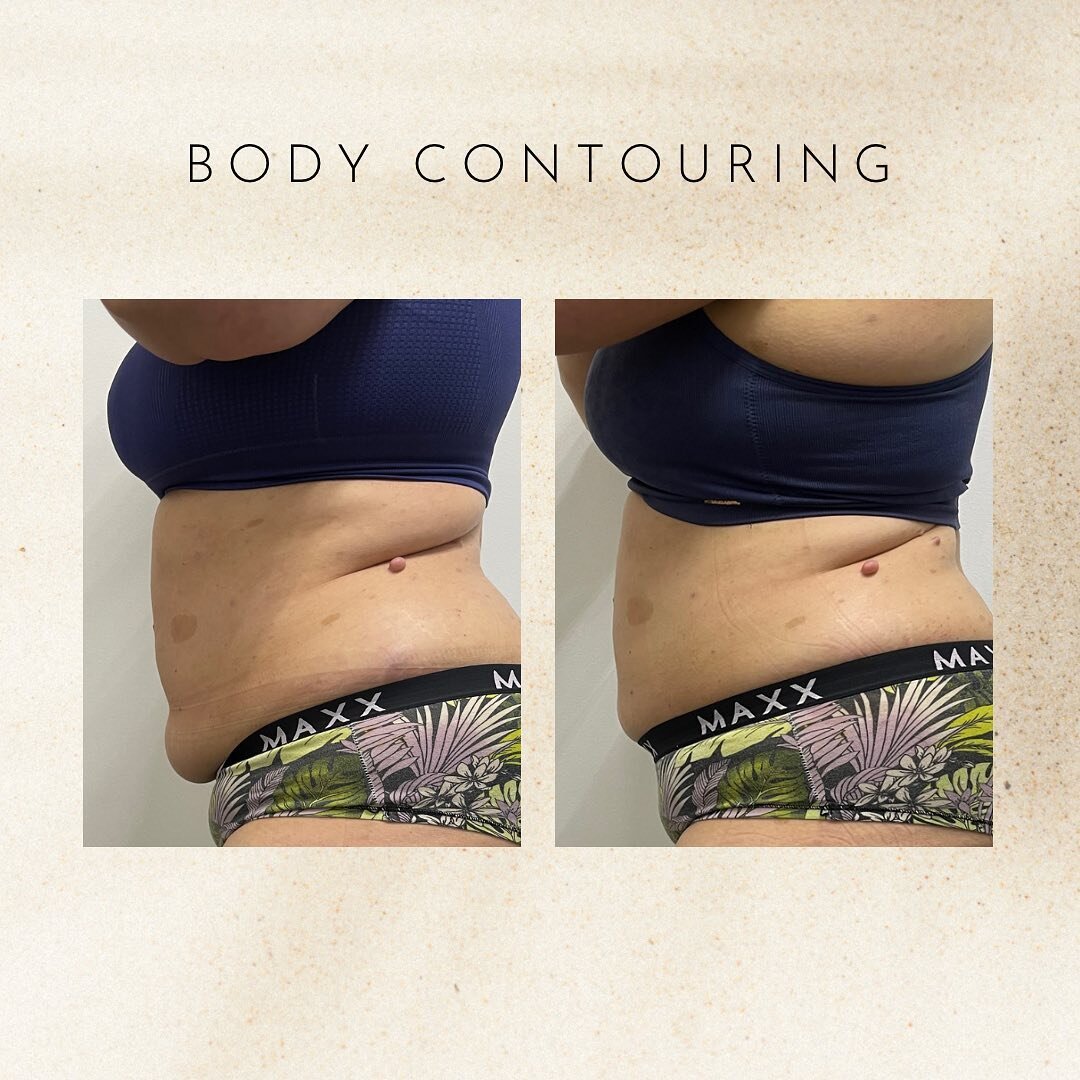 CLIENT RESULTS 
10 sessions of body contouring making all the difference 😍

&bull;
&bull;
&bull;
&bull;
&bull;
&bull;
&bull;
&bull;