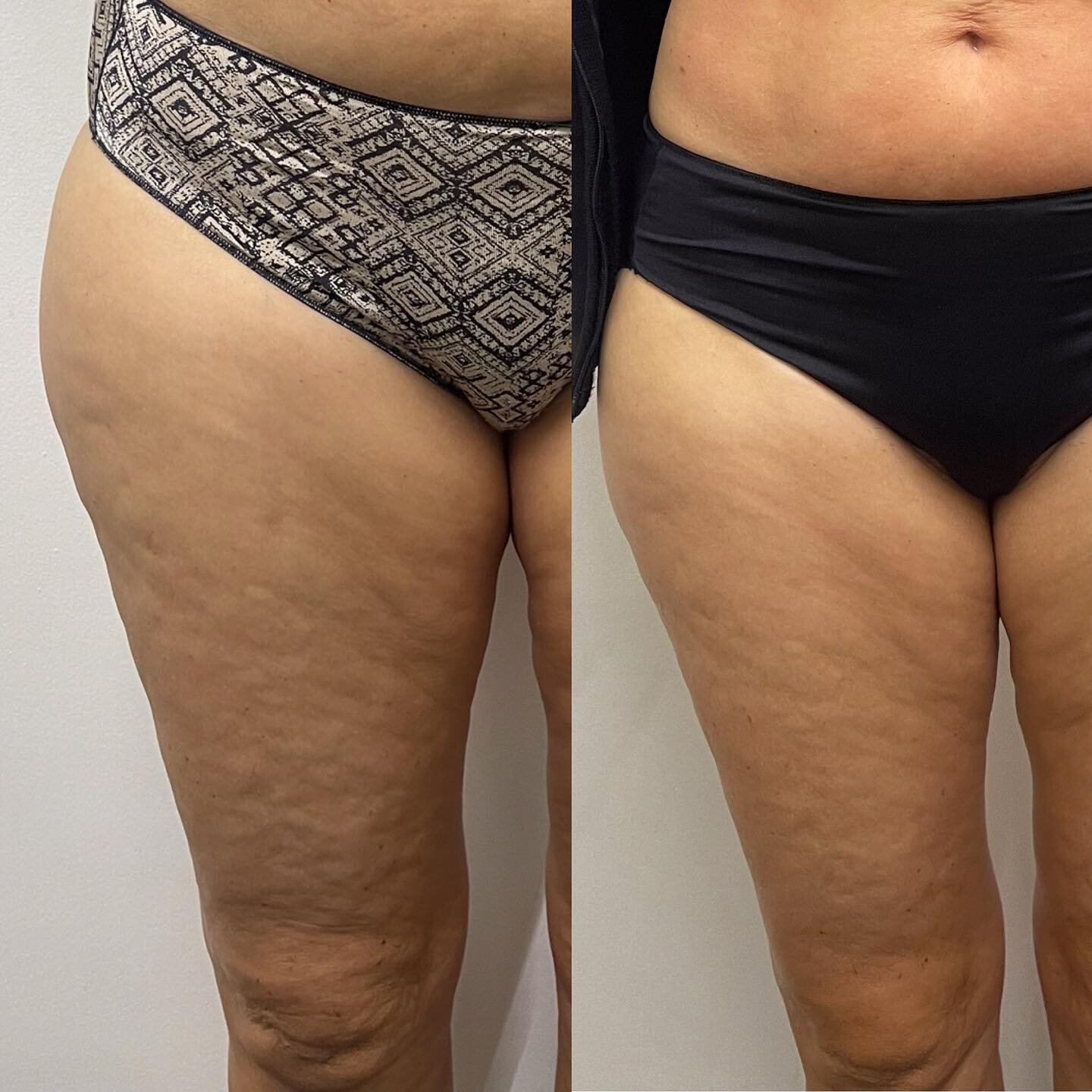 Skin Tightening &amp; Body Contouring results 😍 smoothing out the cellulite in 10 sessions &amp; will continue to improve for 3 months after treatments! 
Book now and claim 40% OFF till the end of July 🤍🤍
&bull;
&bull;
&bull;
&bull;
#slimlux #glob