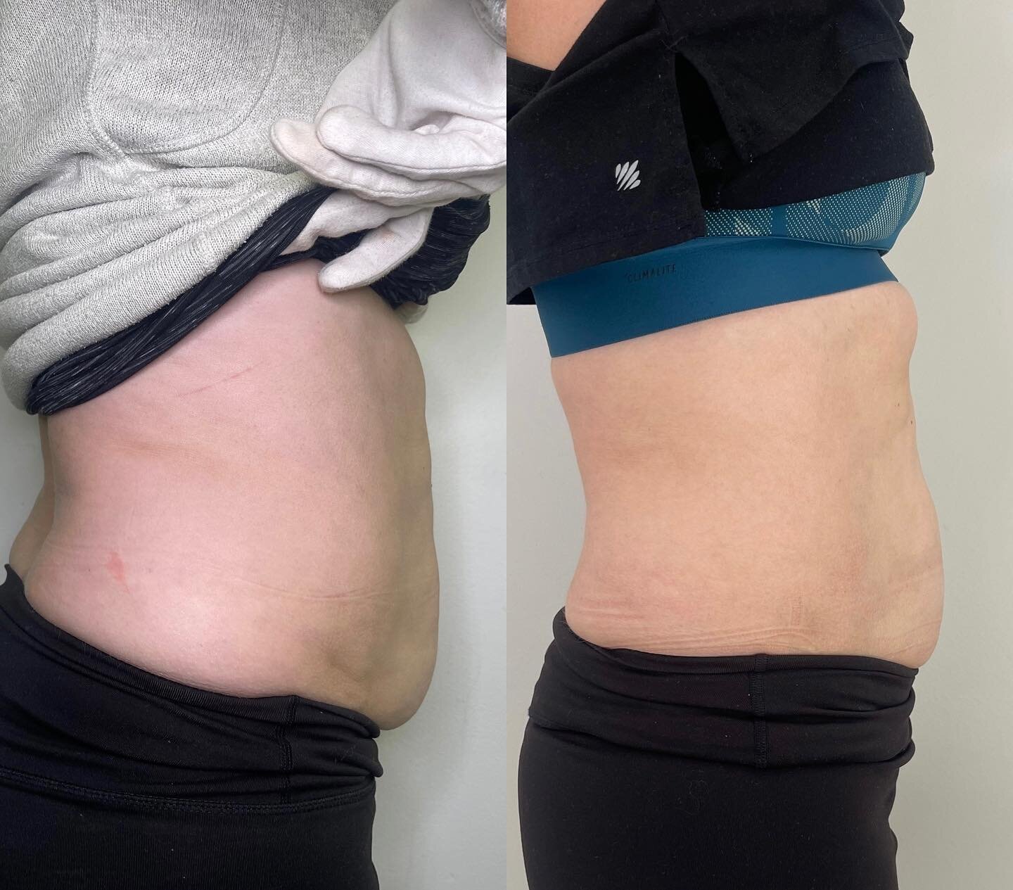 Another amazing result from our Body Contouring. An absolute game changer to kick start or speed up any fitness/weight loss journey! 
&bull;
&bull;
&bull;
&bull;
&bull;
#slimlux #globalbeautygroup #bodycontouring #bodycontour #fatdissolving #fatcav #