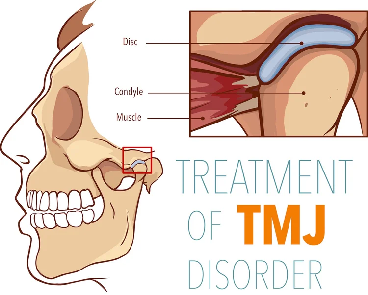 Tmj Spasm What is TMJ? Overview of Symptoms and Causes — Dr. Erich W. Herber DDS