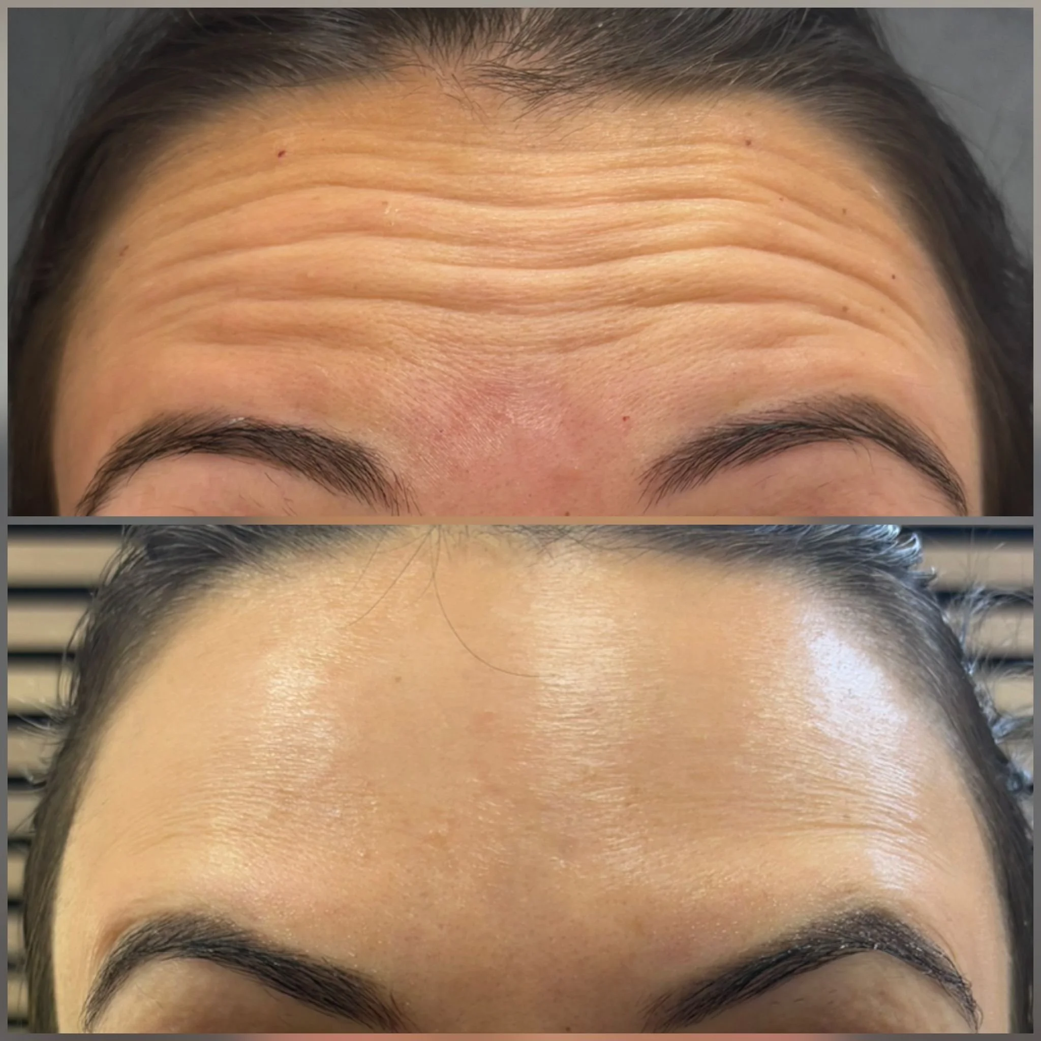 Anti Wrinkle Injections — NAS BEAUTY — NAS BEAUTY
