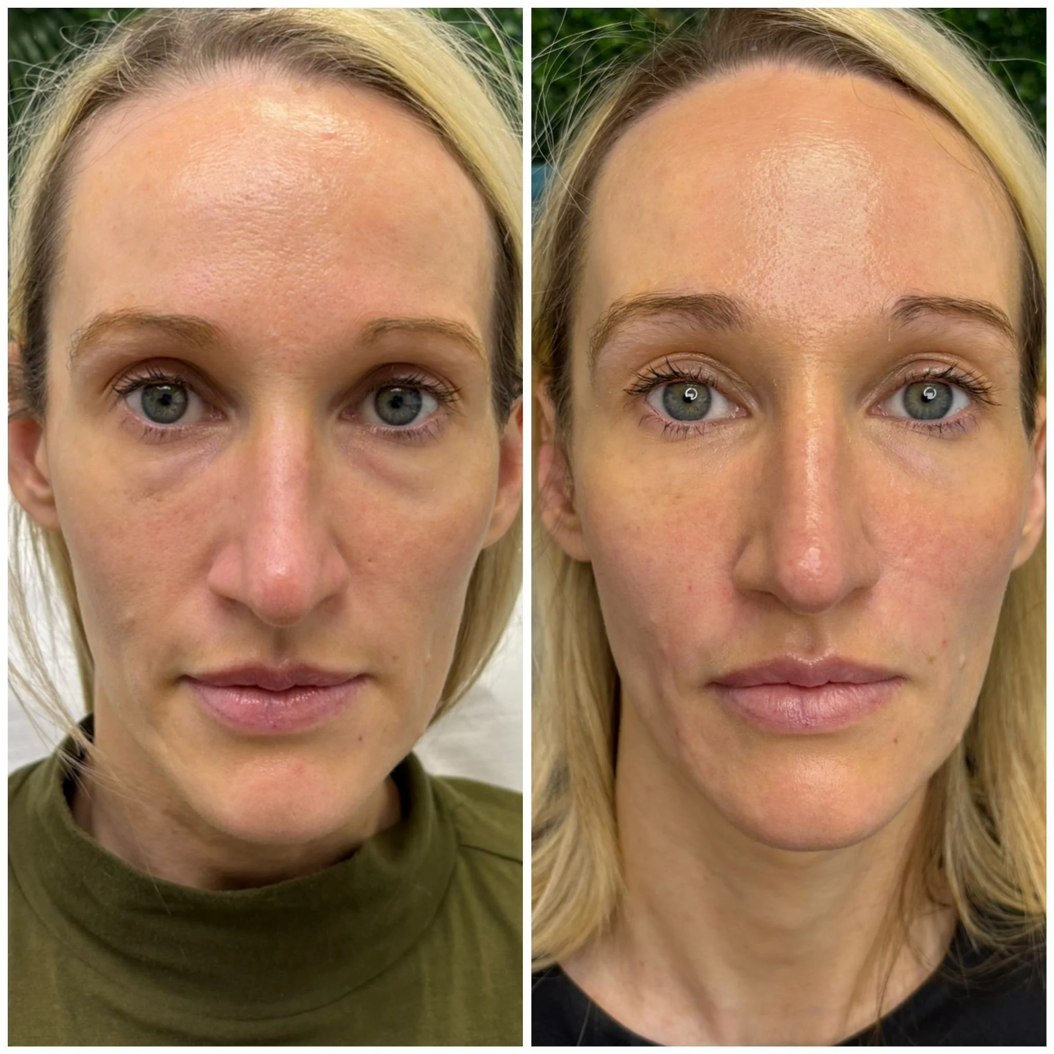Hifu & Dermal Fillers