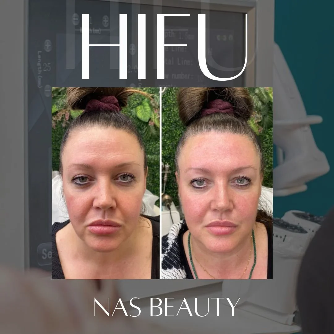 NON surgical facelift