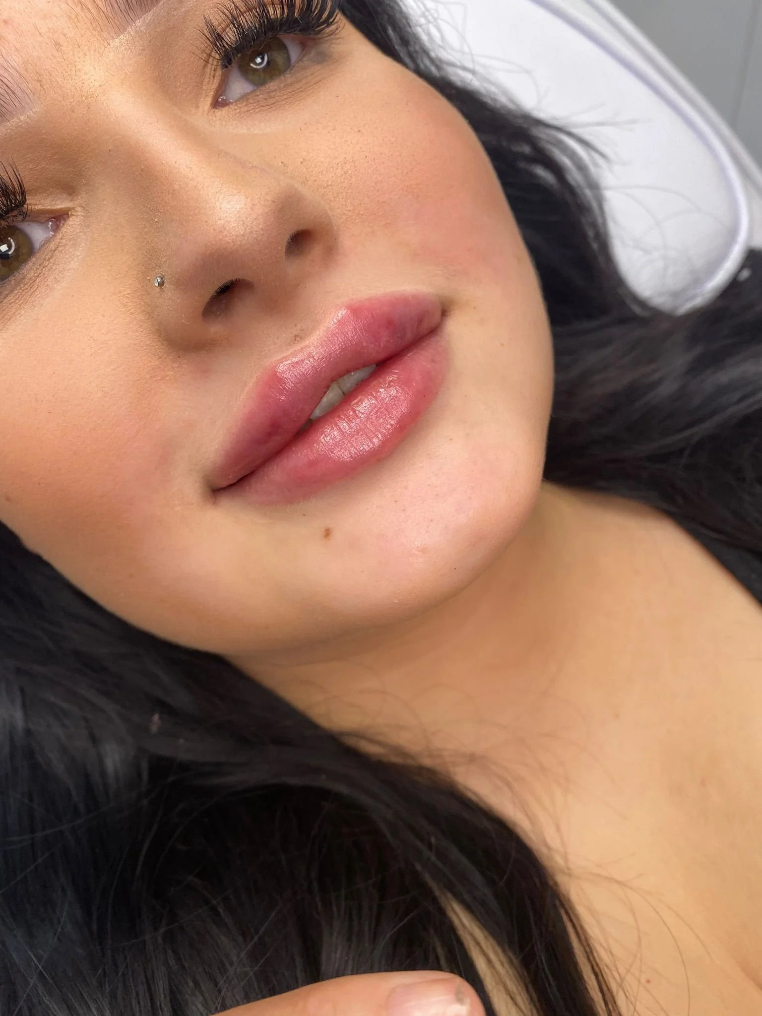 Dermal Fillers