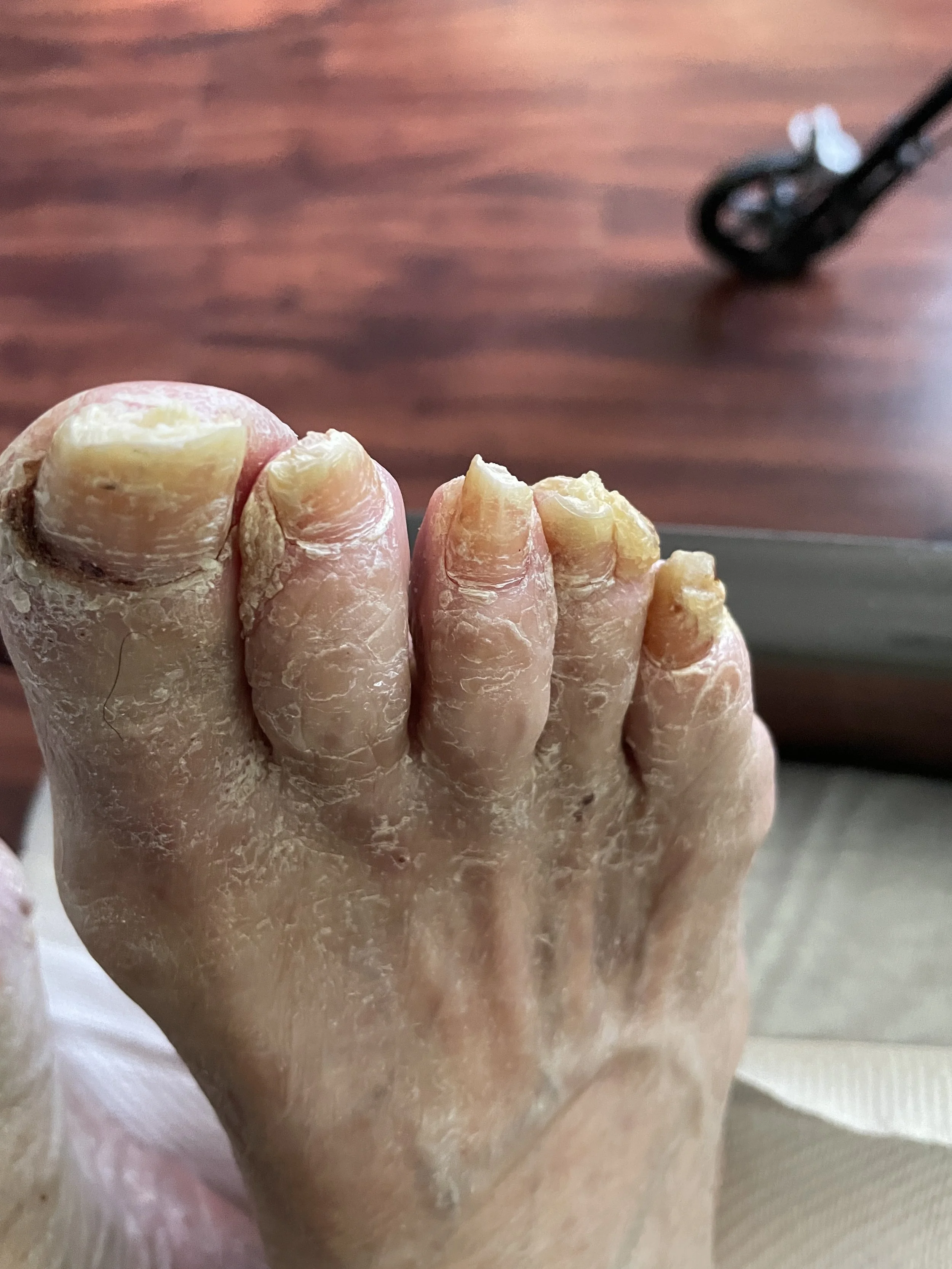senior toenail trimming