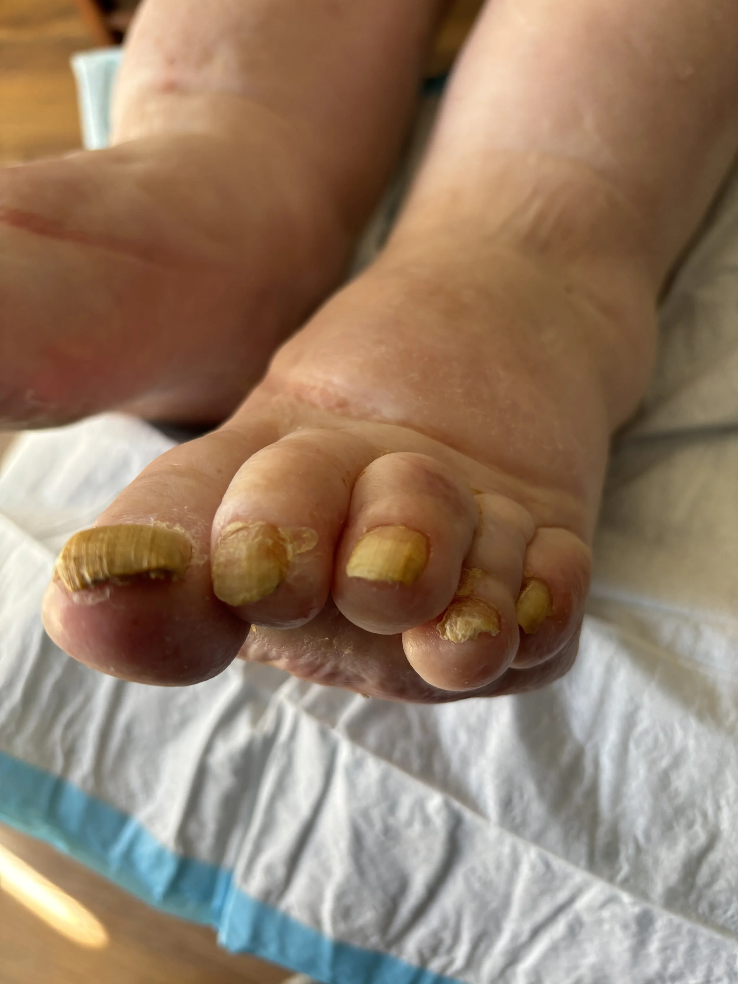Close-up of a foot with severely ingrown toenails on all five toes