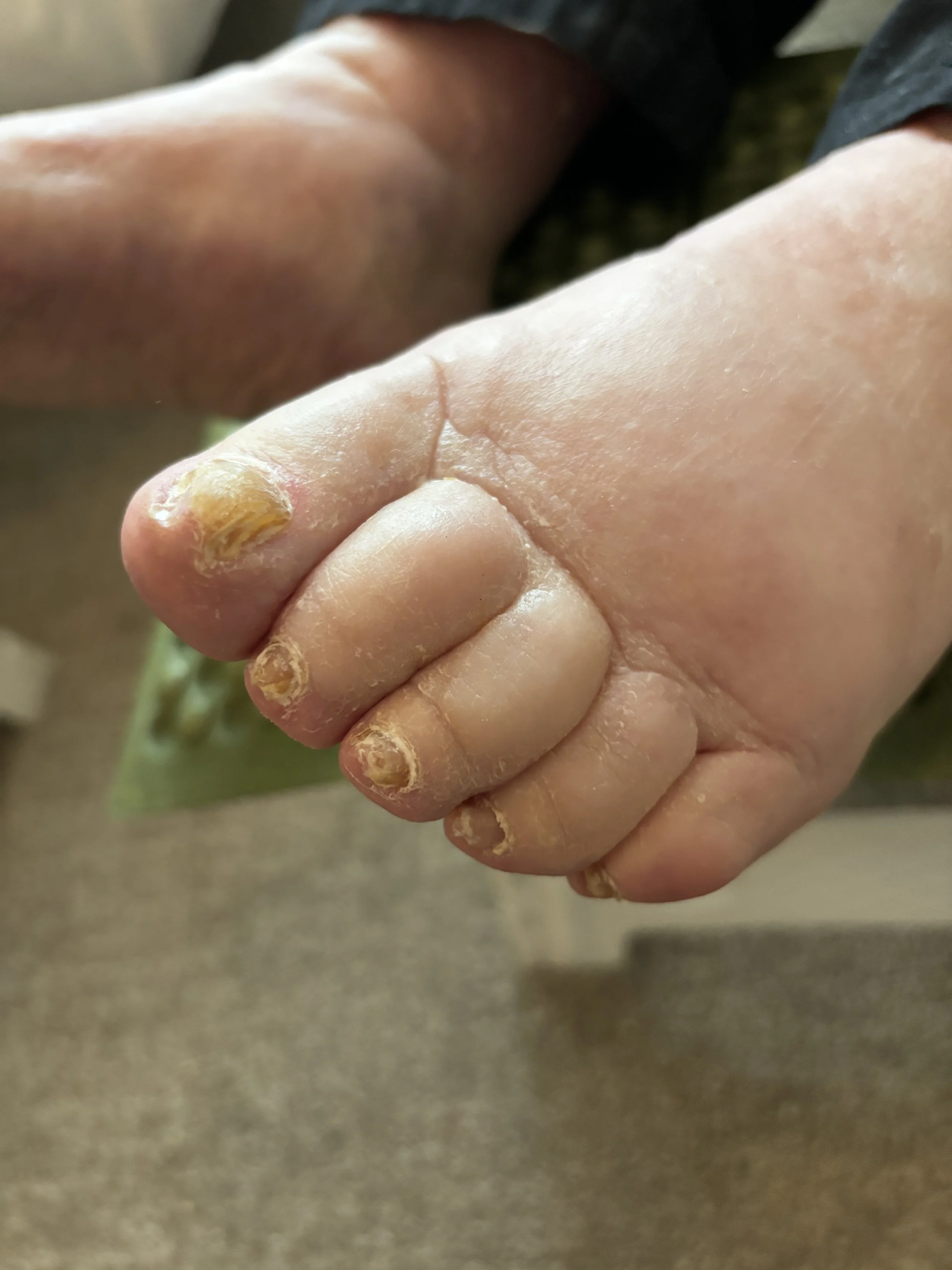 Close-up of a child's foot with dry, cracked, and peeling toenails.