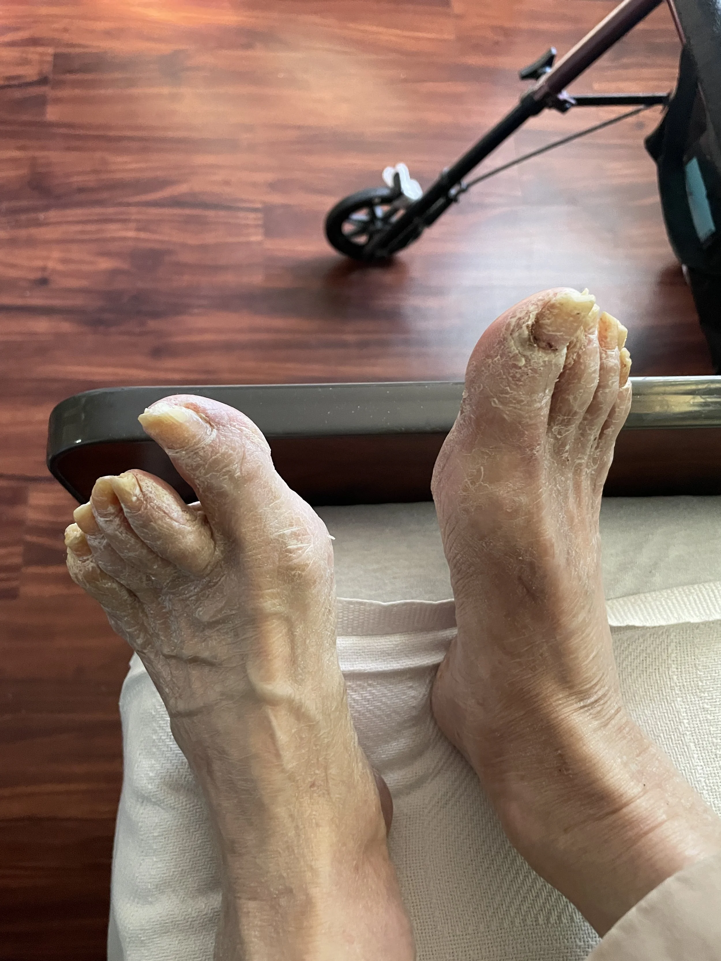 Elderly person's dried and cracked feet resting on a wheelchair's armrest, with a wooden floor in the background.