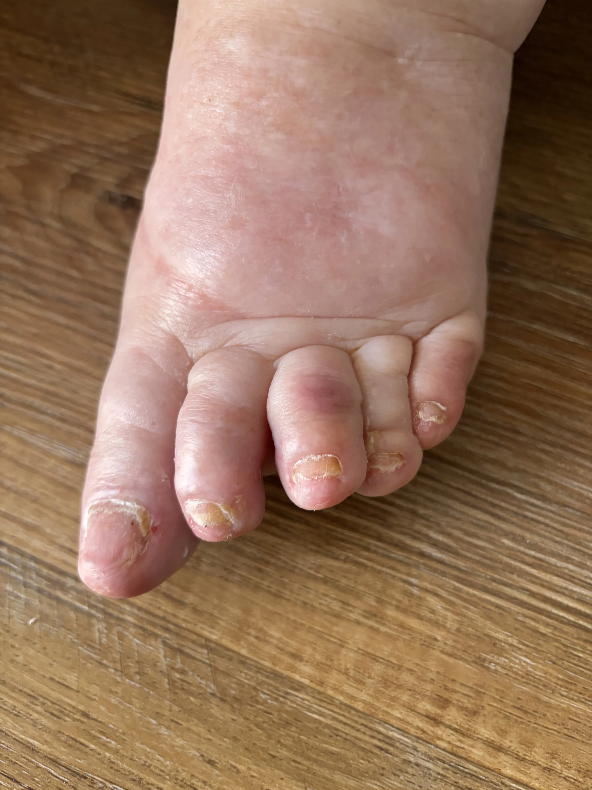 Close-up of a person's foot with toenails that are thickened, discolored, and peeling, indicating possible fungal infection.