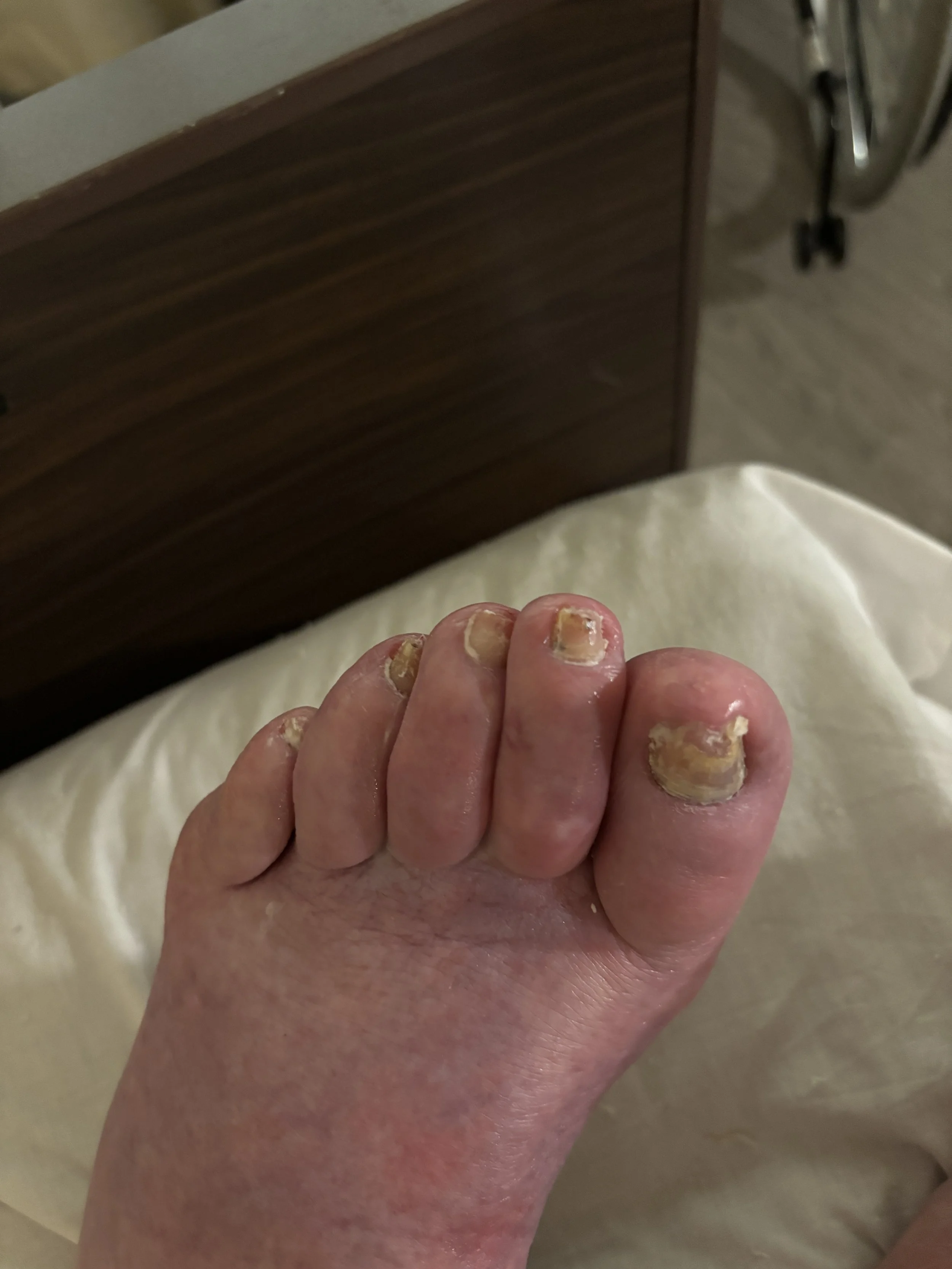 Close-up of a foot with severely ingrown and infected toenails, showing redness and swelling around the nails.