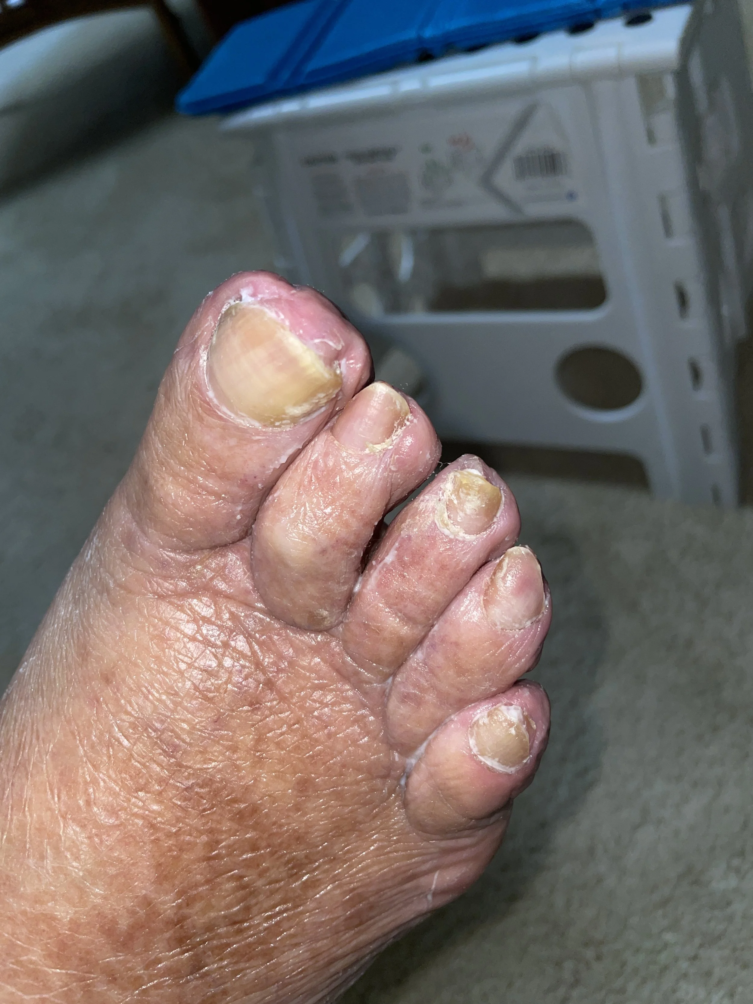 Close-up of a person's foot with toenails that are thickened, discolored, and damaged, indicating possible fungal toenail infection.