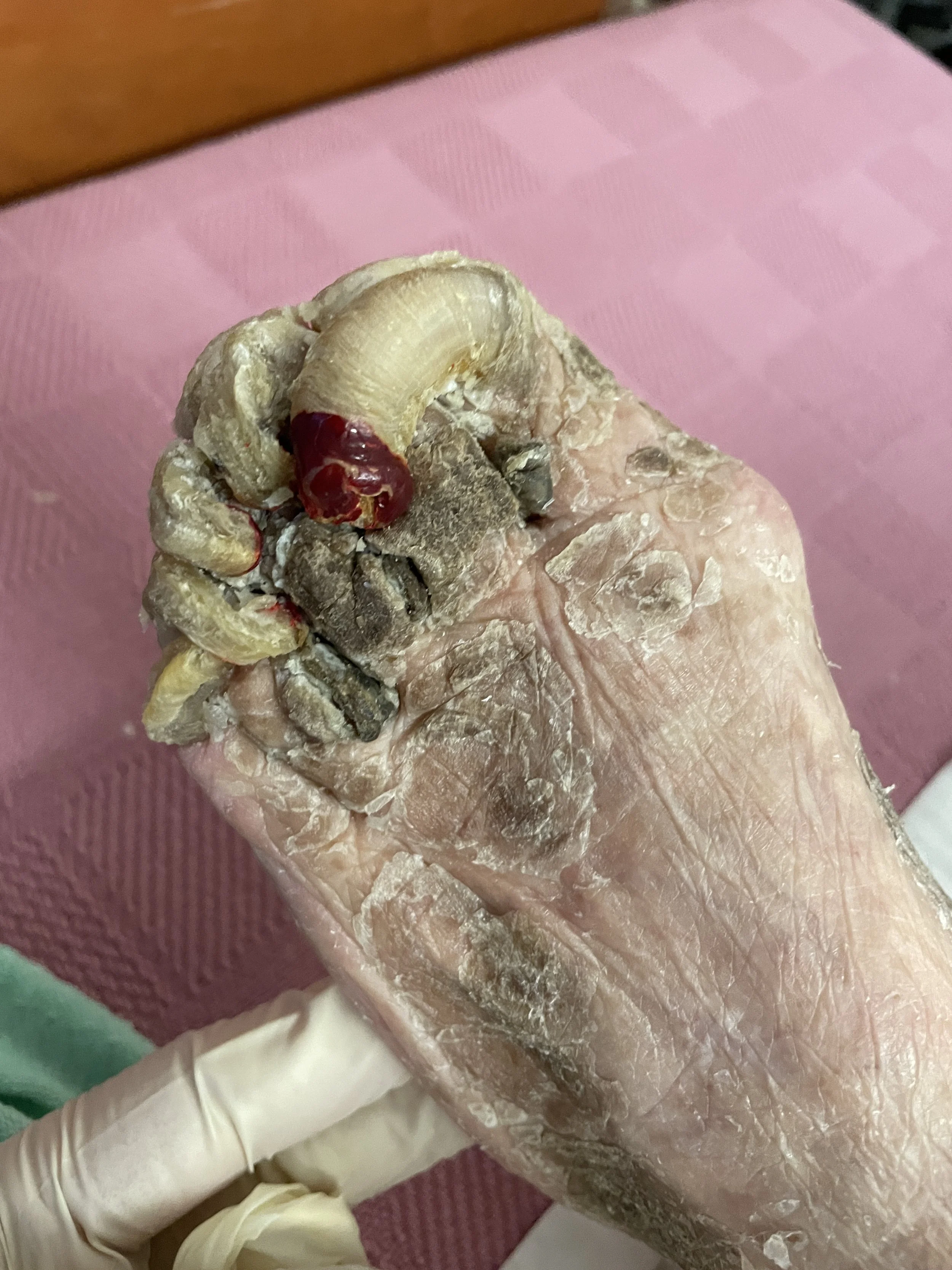 A foot with decayed toes covered in a layer of dead skin and fungi, with some toes appearing swollen and discolored, indicating severe infection or disease.