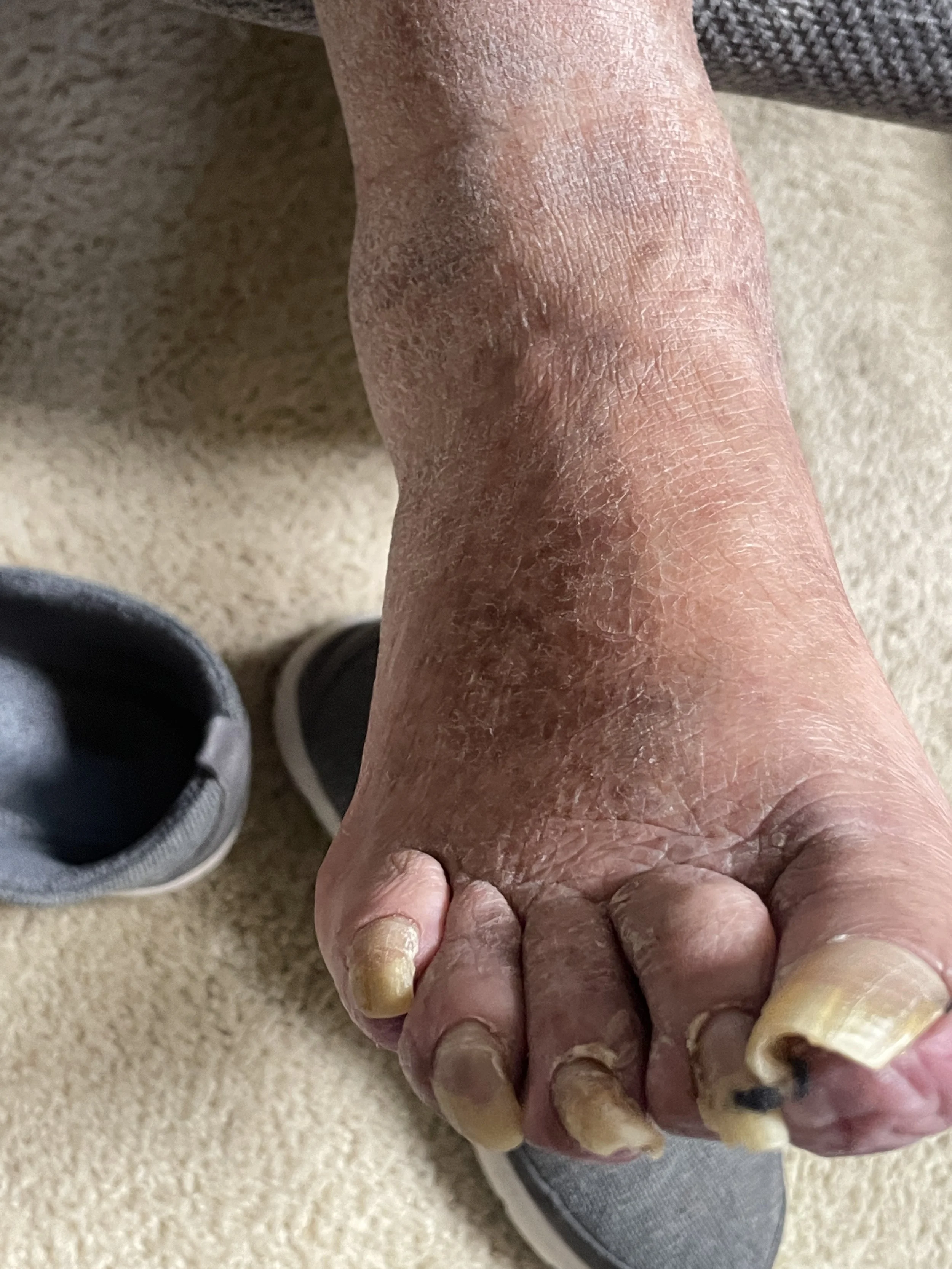Close-up of an elderly person's foot with thick toenails and dry, cracked skin on the heel, on a beige carpet with a shoe nearby.