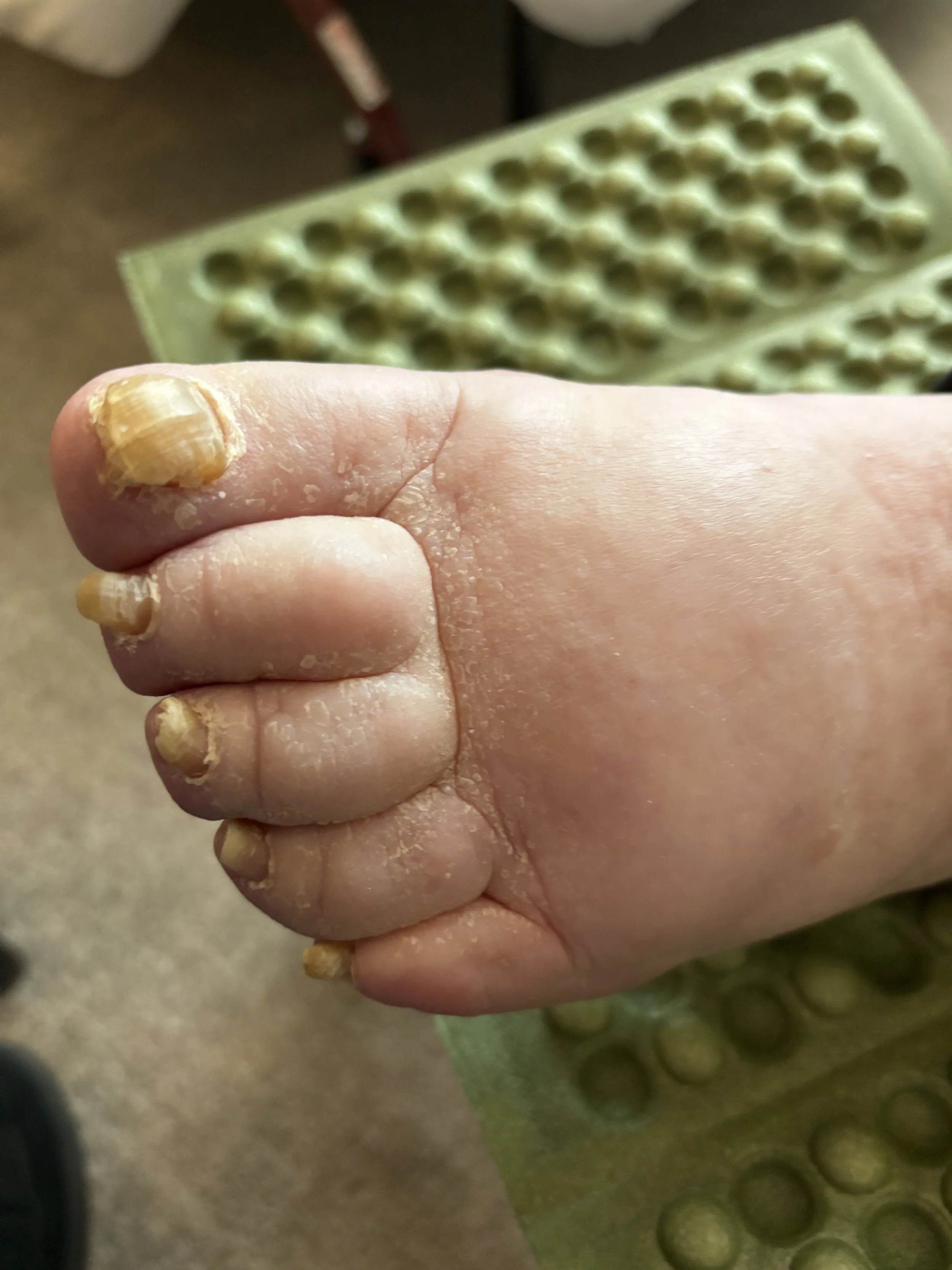 Close-up of a person's toes with thickened, discolored toenails, and dry skin, with an orthotic insert and a green foot cushion in the background.