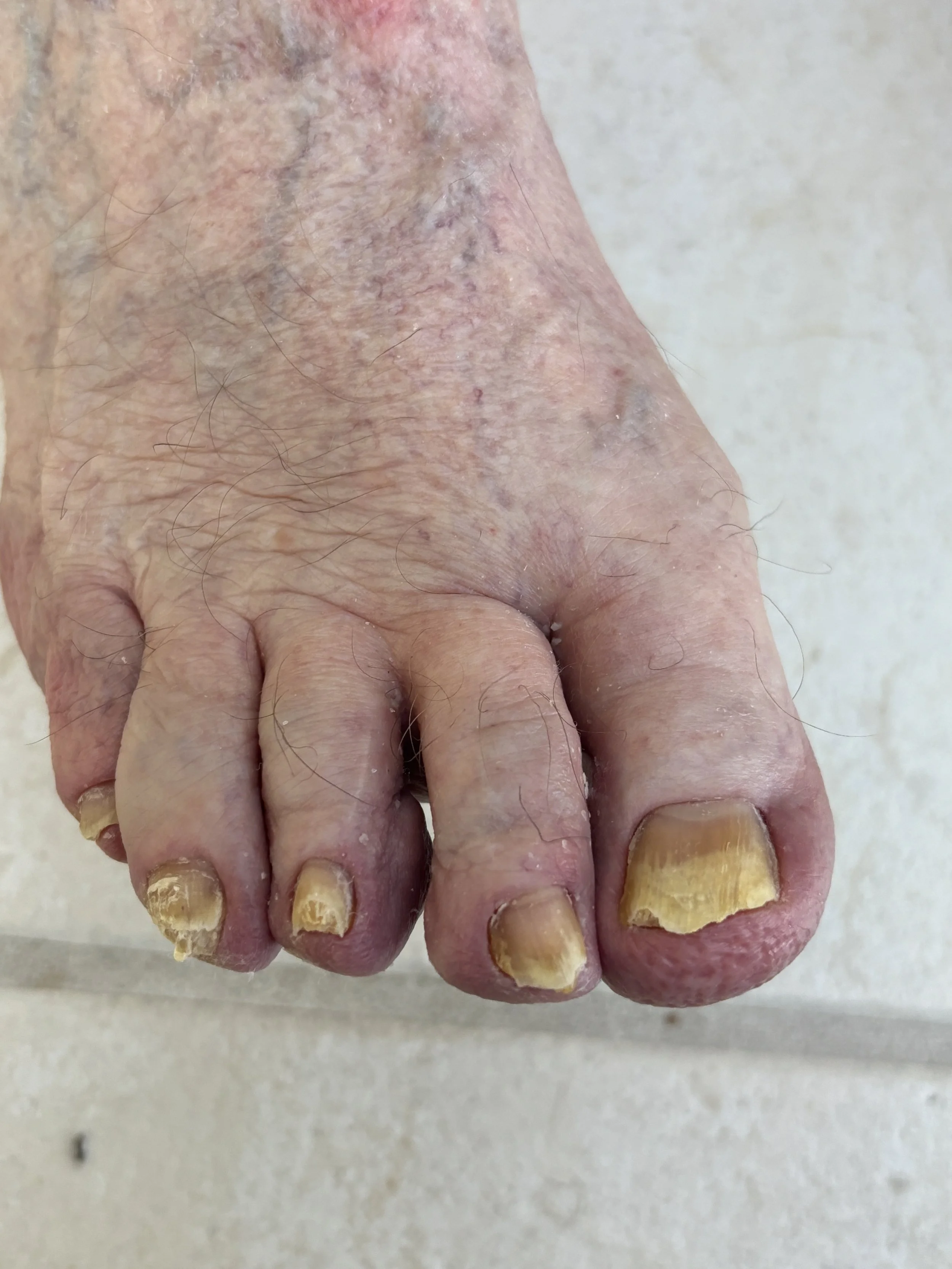 left foot with fungal toenails before