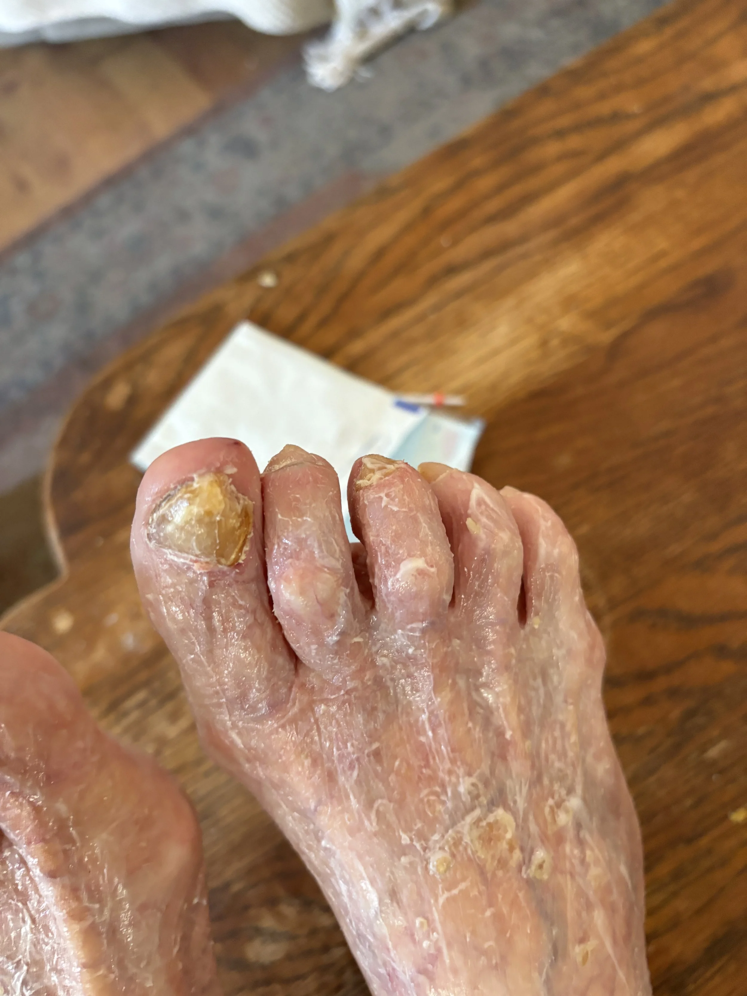 Close-up of a person's foot with dry, cracked, and peeling skin on the toes and toenails, resting on a wooden surface.
